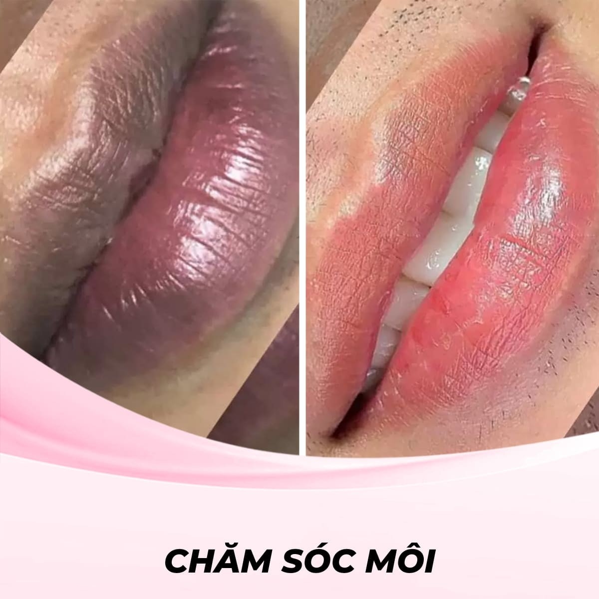 Khử thâm môi bằng phương pháp laser
