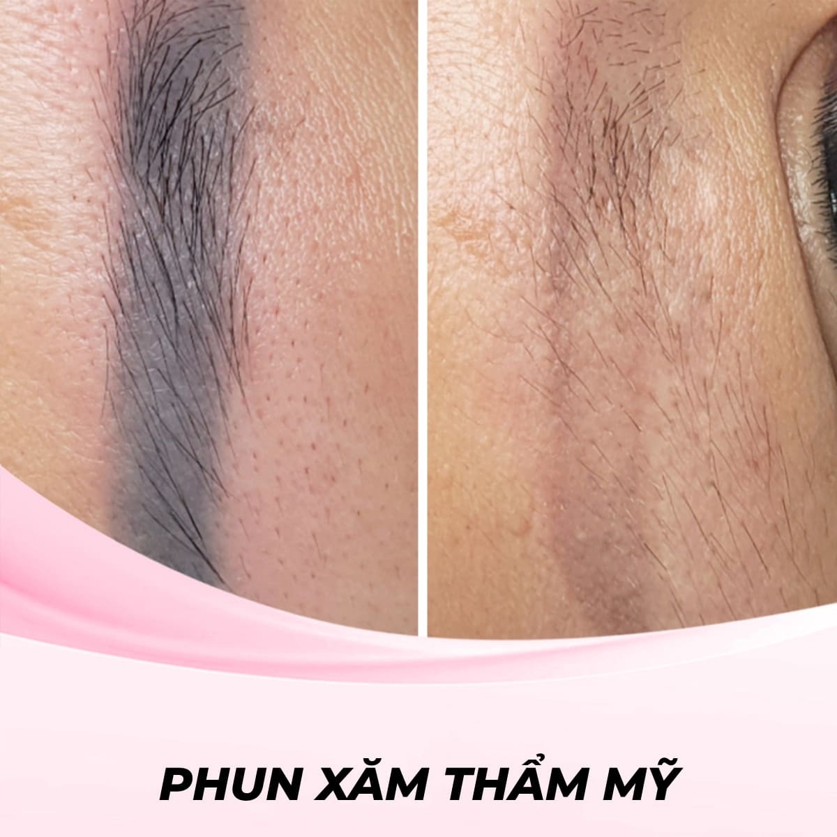 Xóa xăm lông mày bằng công nghệ Plasma
