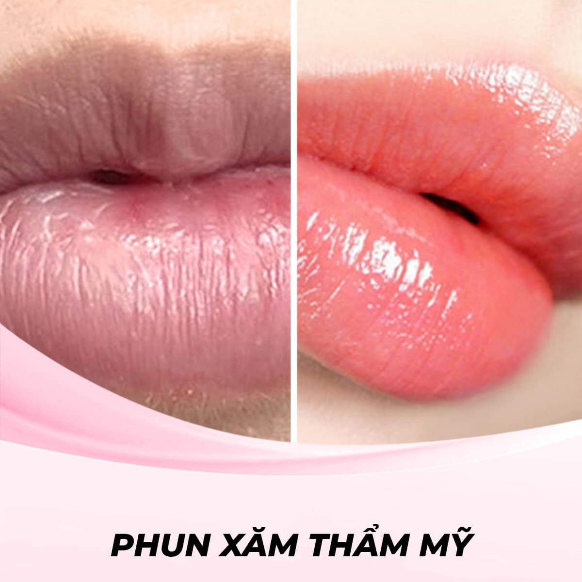Phun Môi Collagen