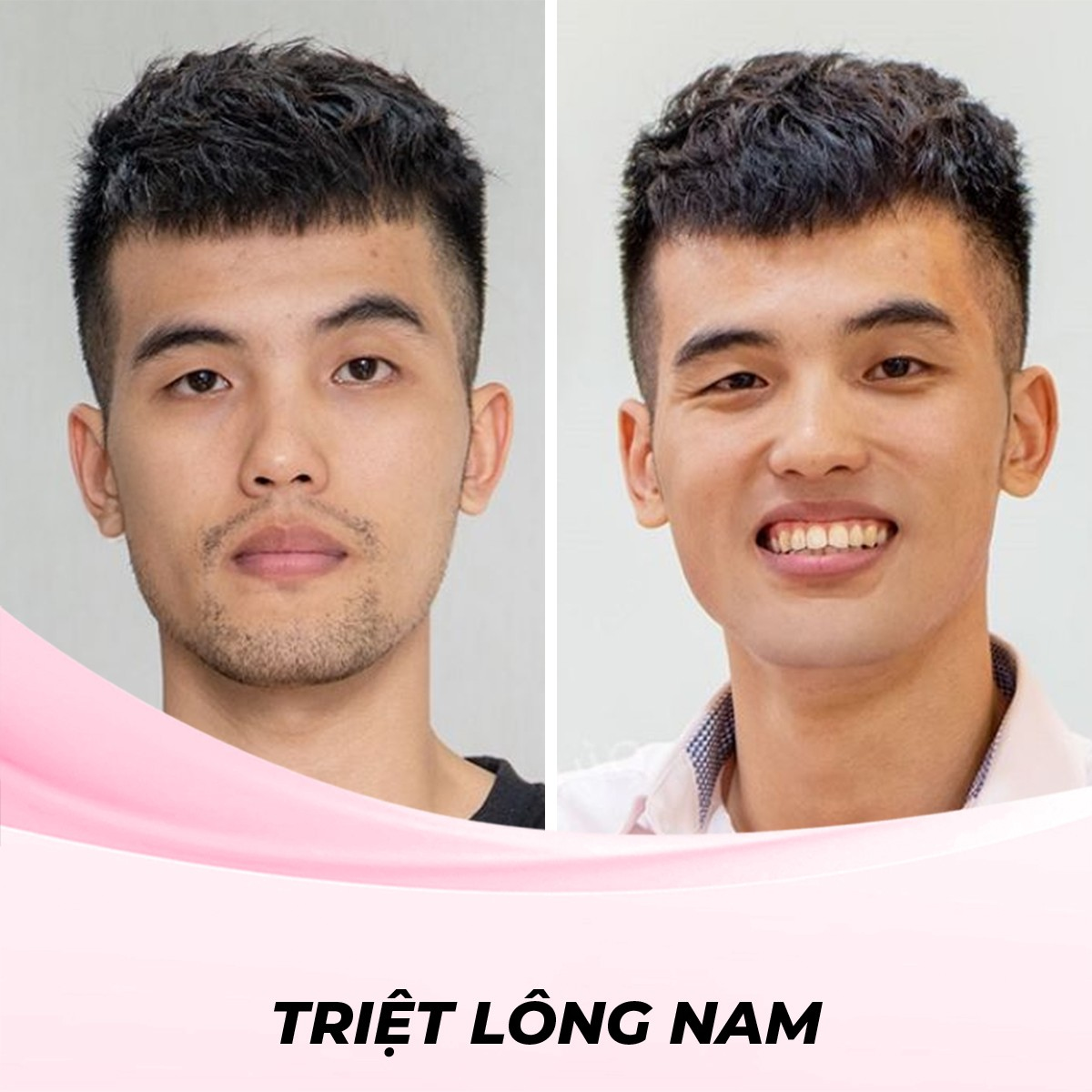 Triệt Lông Mặt Cho Nam Bằng Phương Pháp  Waxing