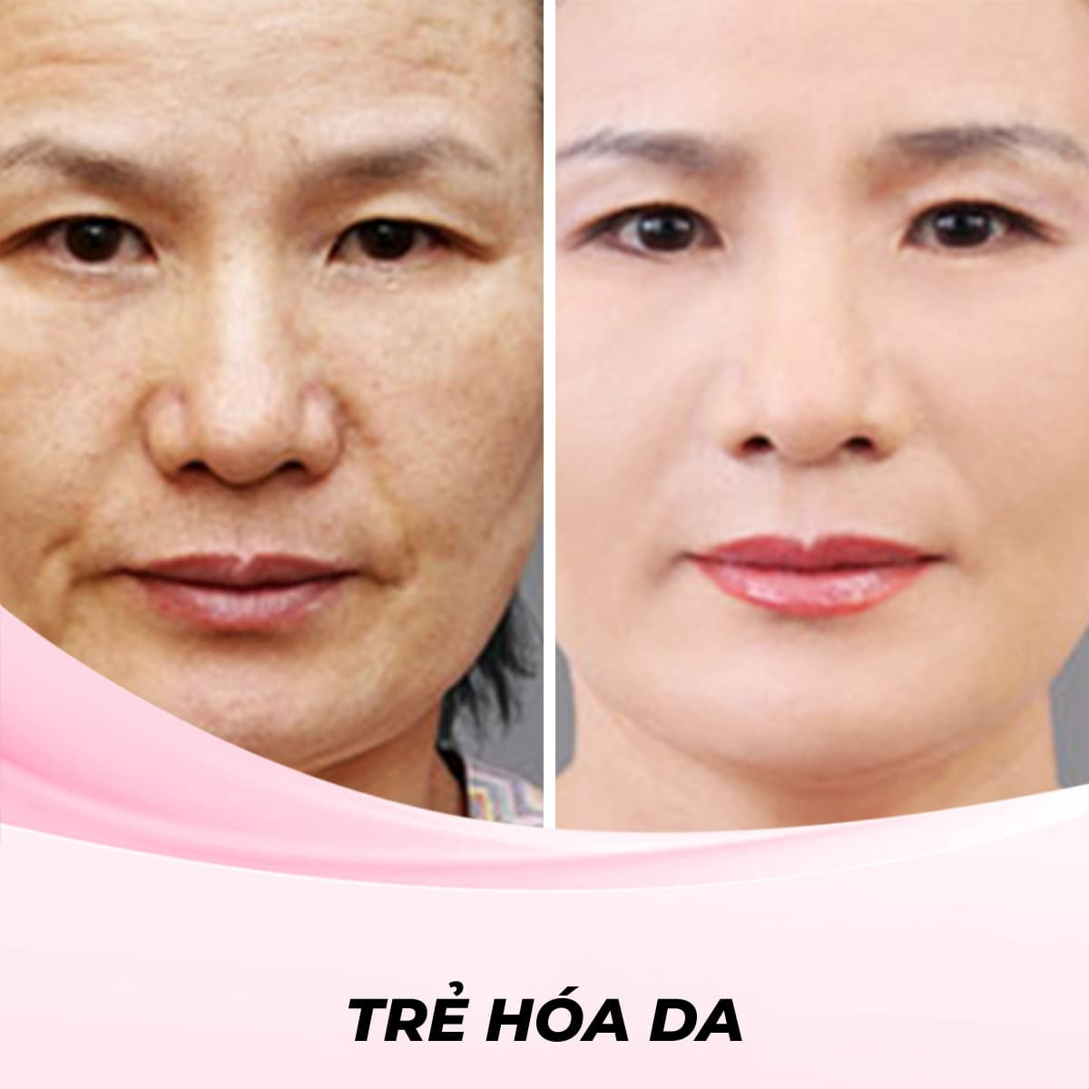 Trẻ Hóa Da Bằng Laser Fractional Co2