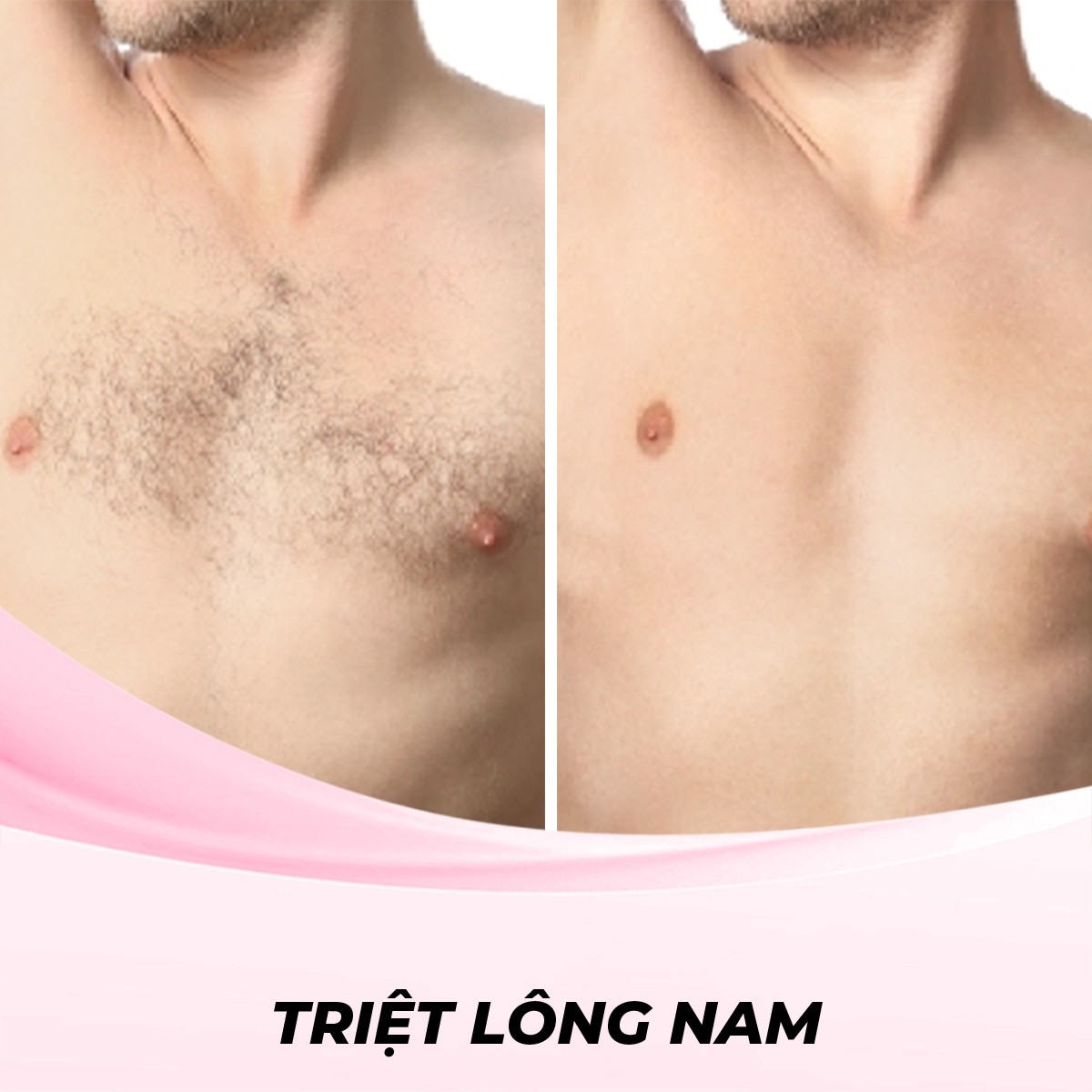 Triệt Lông Ngực cho Nam Bằng Công Nghệ Nd Laser