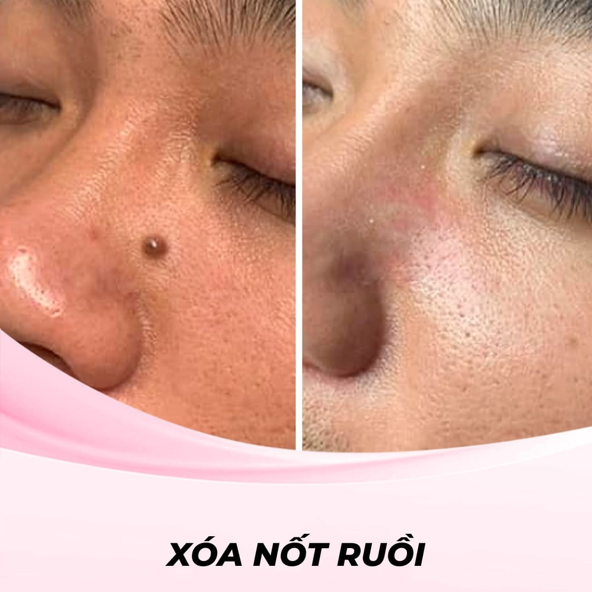 Dịch Vụ Xóa Nốt Ruồi Bằng Sóng RF (Radio Frequency)
