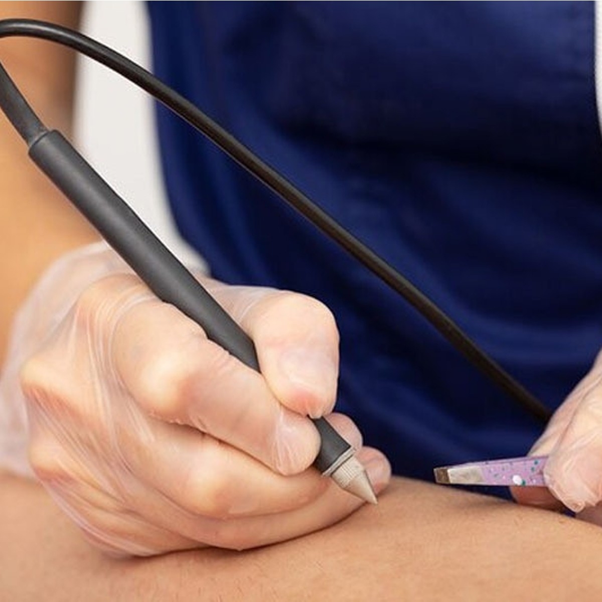 Dịch vụ Triệt Lông Chân cho nam bằng Electrolysis (Điện phân)