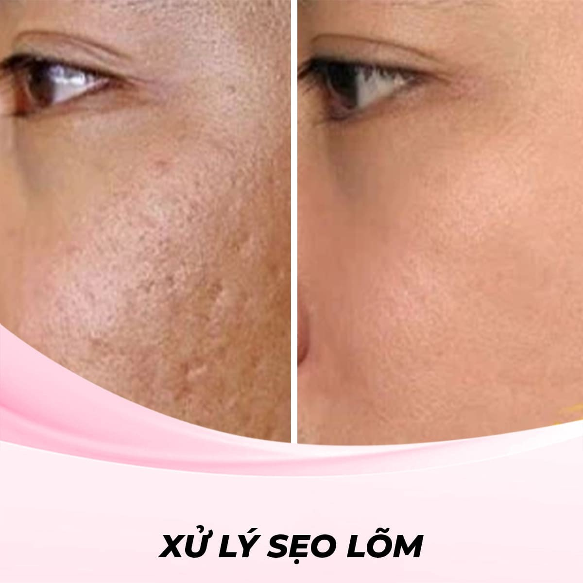 Xử Lý Sẹo Lõm Bằng Sóng Radiofrequency (RF)