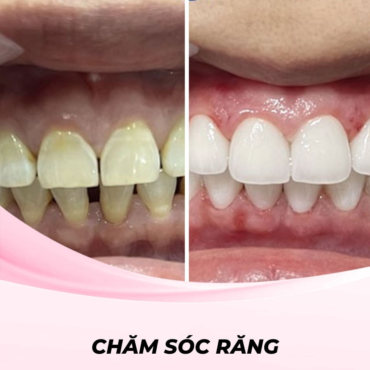 Lắp Đặt Răng Sứ Sage Shine