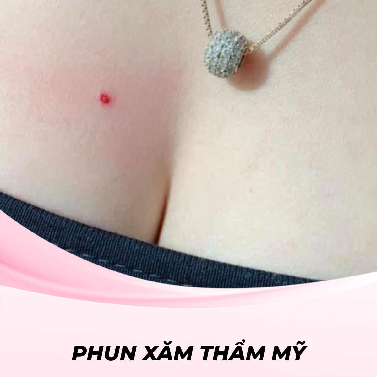 Tạo Nốt Ruồi Son May Mắn, Tài Lộc Ở Ngực
