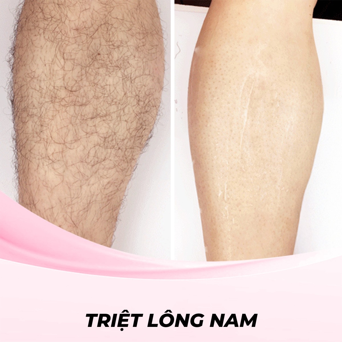 Dịch vụ Triệt Lông Chân cho nam bằng Electrolysis (Điện phân)