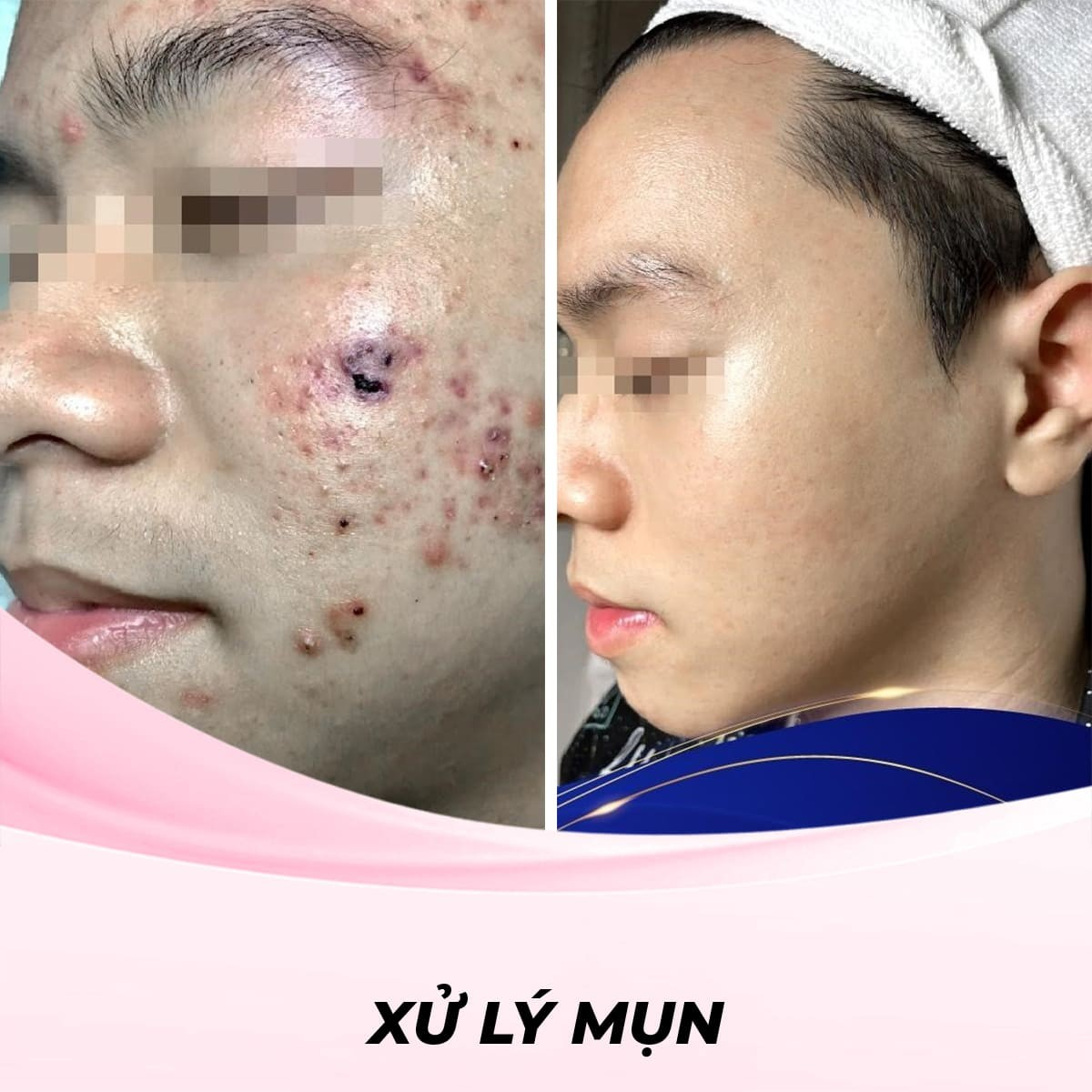 Xử lý mụn bằng công nghệ Plasma