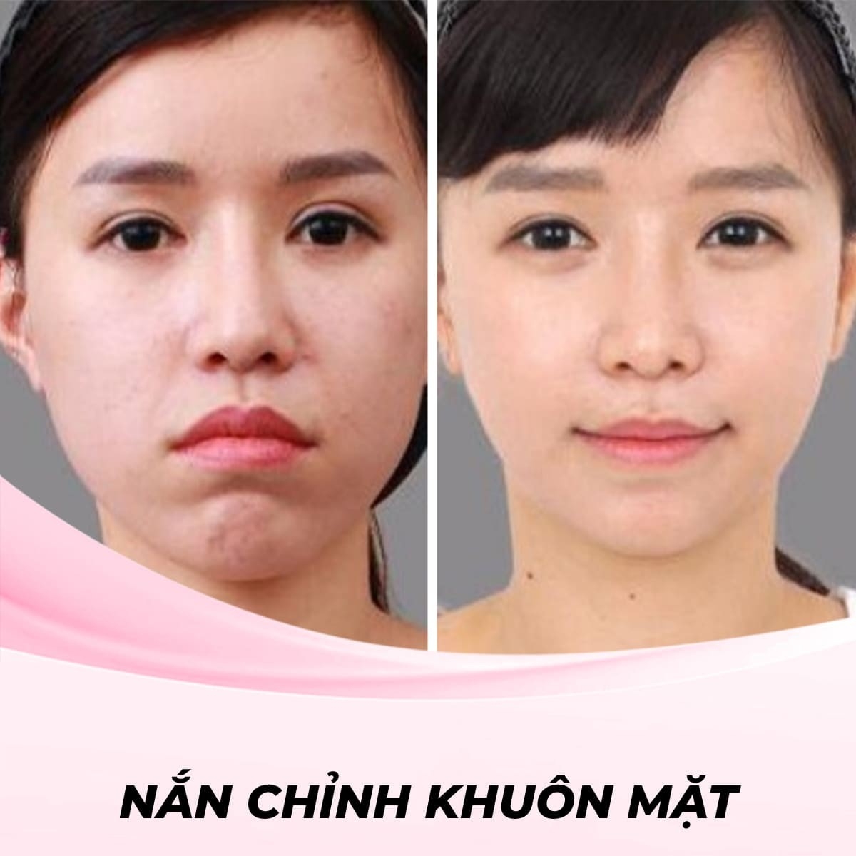 Dịch vụ nắn chỉnh khuôn mặt bằng phương pháp căng chỉ (Thread Lift)