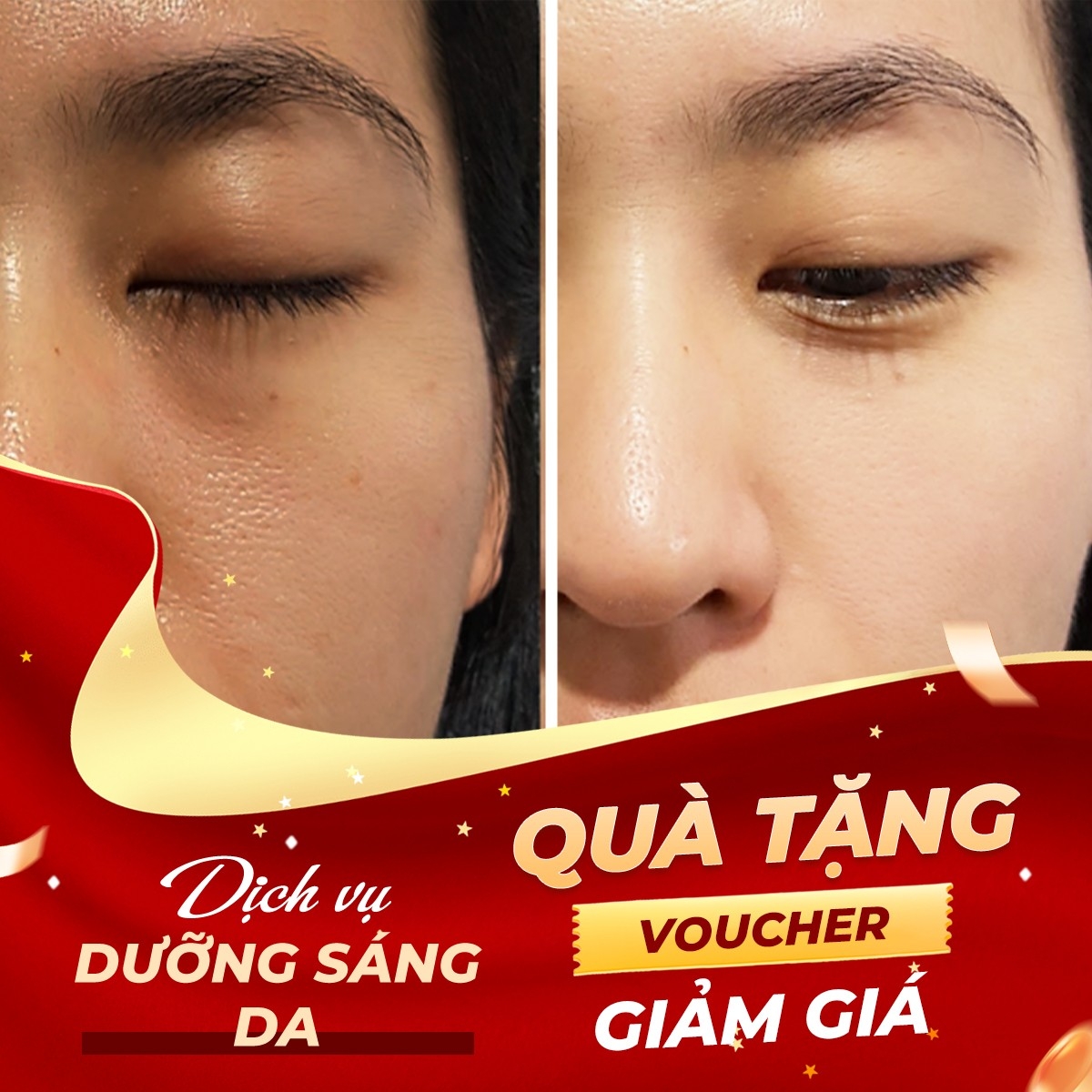 Voucher giảm giá dịch vụ dưỡng sáng da Meso - Da mặt