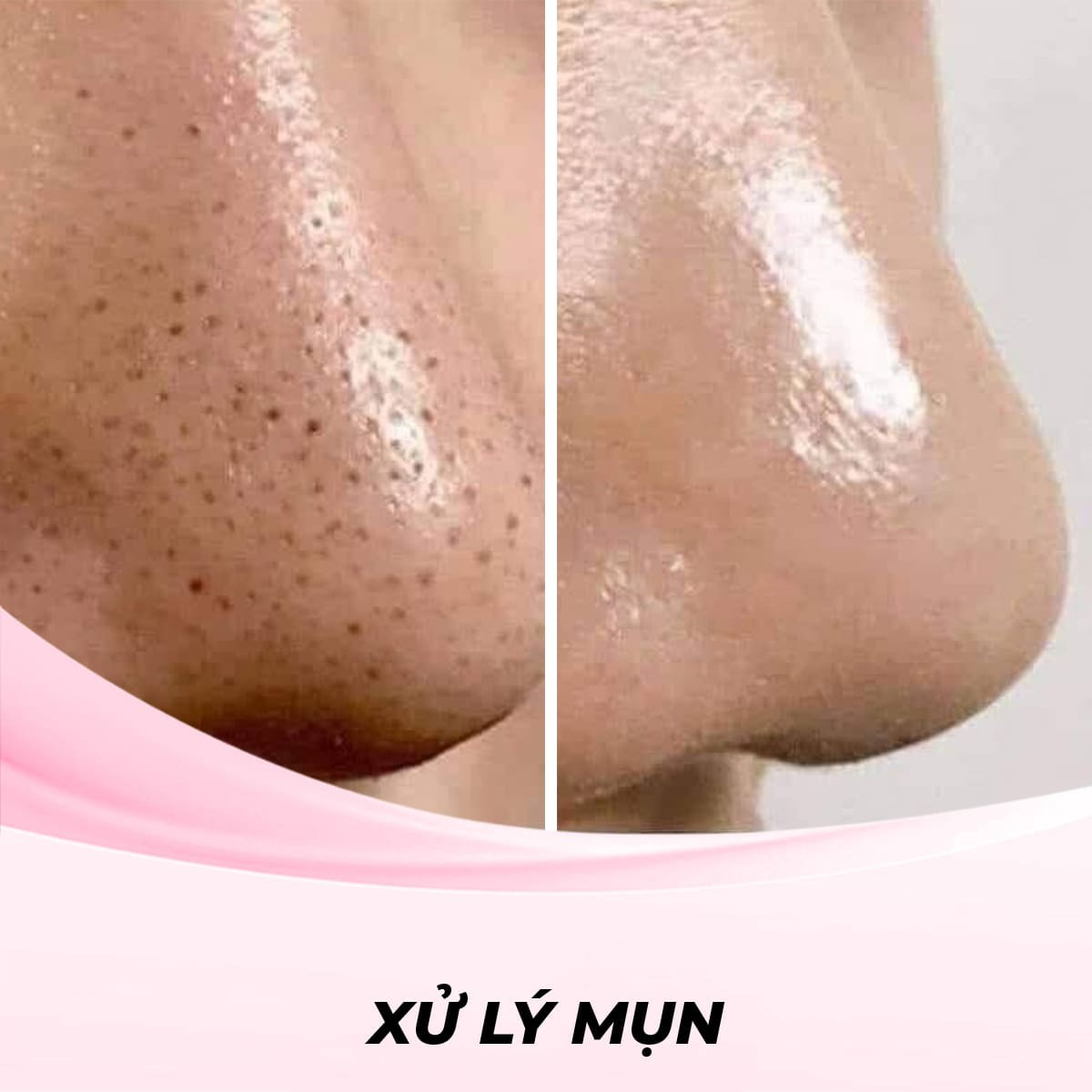 Phương Pháp Hút Mụn Đầu Đen