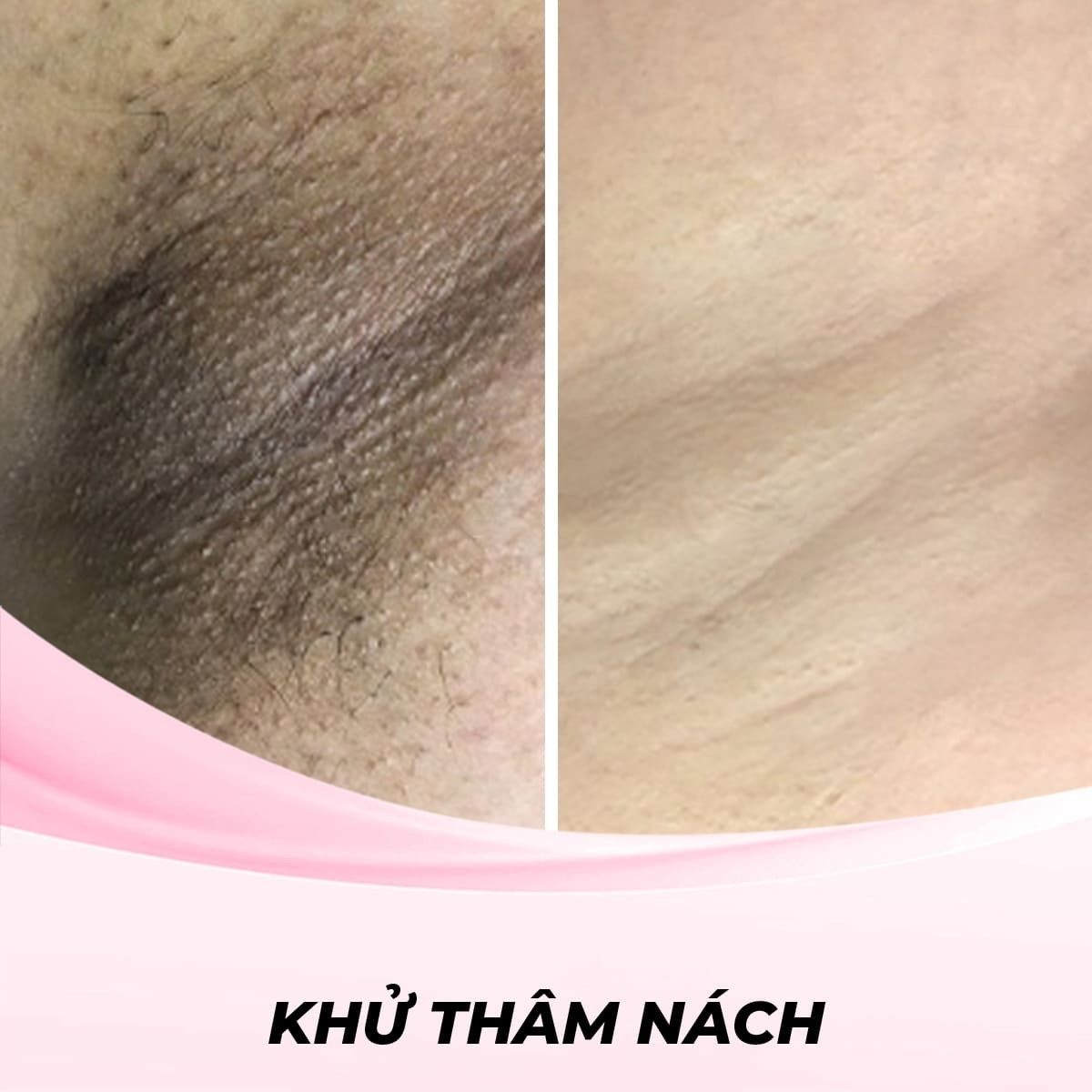 Phương pháp xông hơi và đắp mặt nạ khử thâm nách