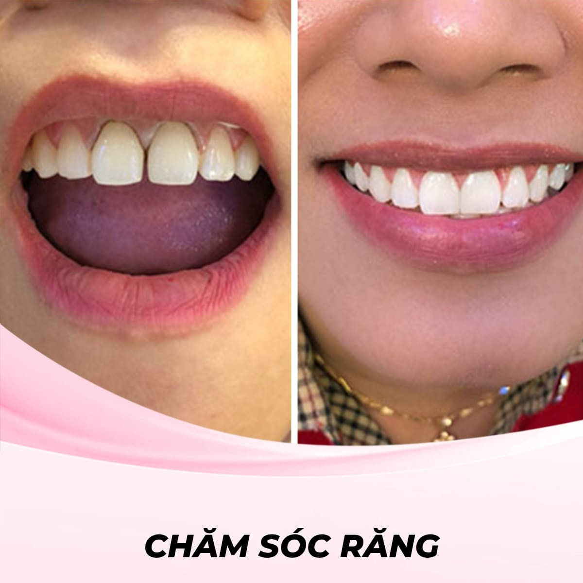 Dán Sứ Viva Ultrathin