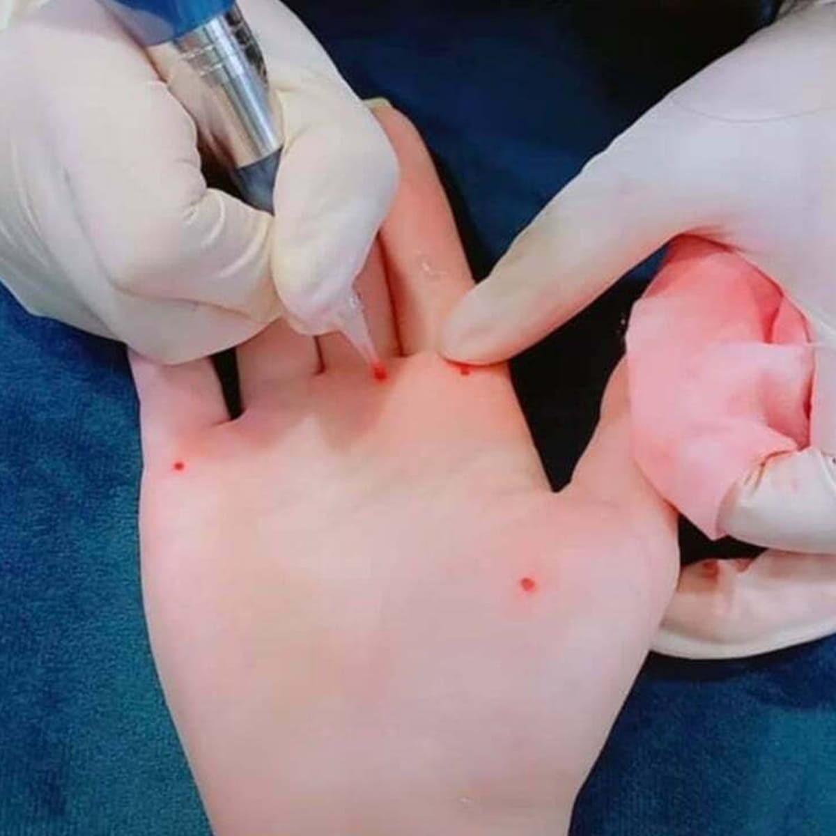 Tạo nốt ruồi ở lòng bàn tay phải bằng phương pháp phun thêu