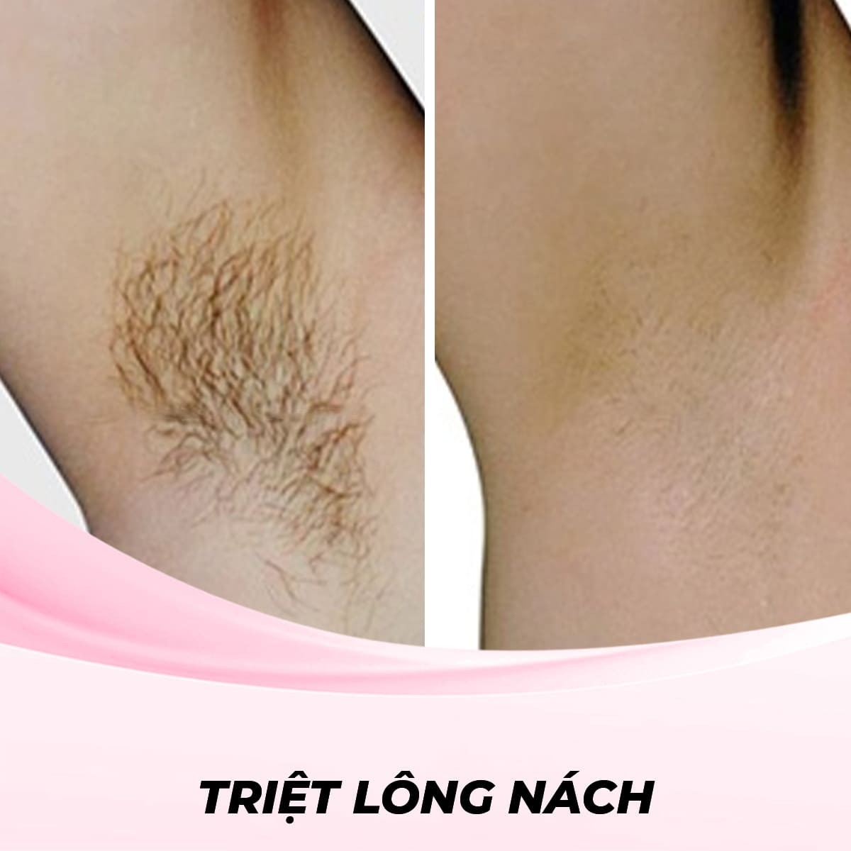 Triệt lông nách bằng công nghệ Điện Phân