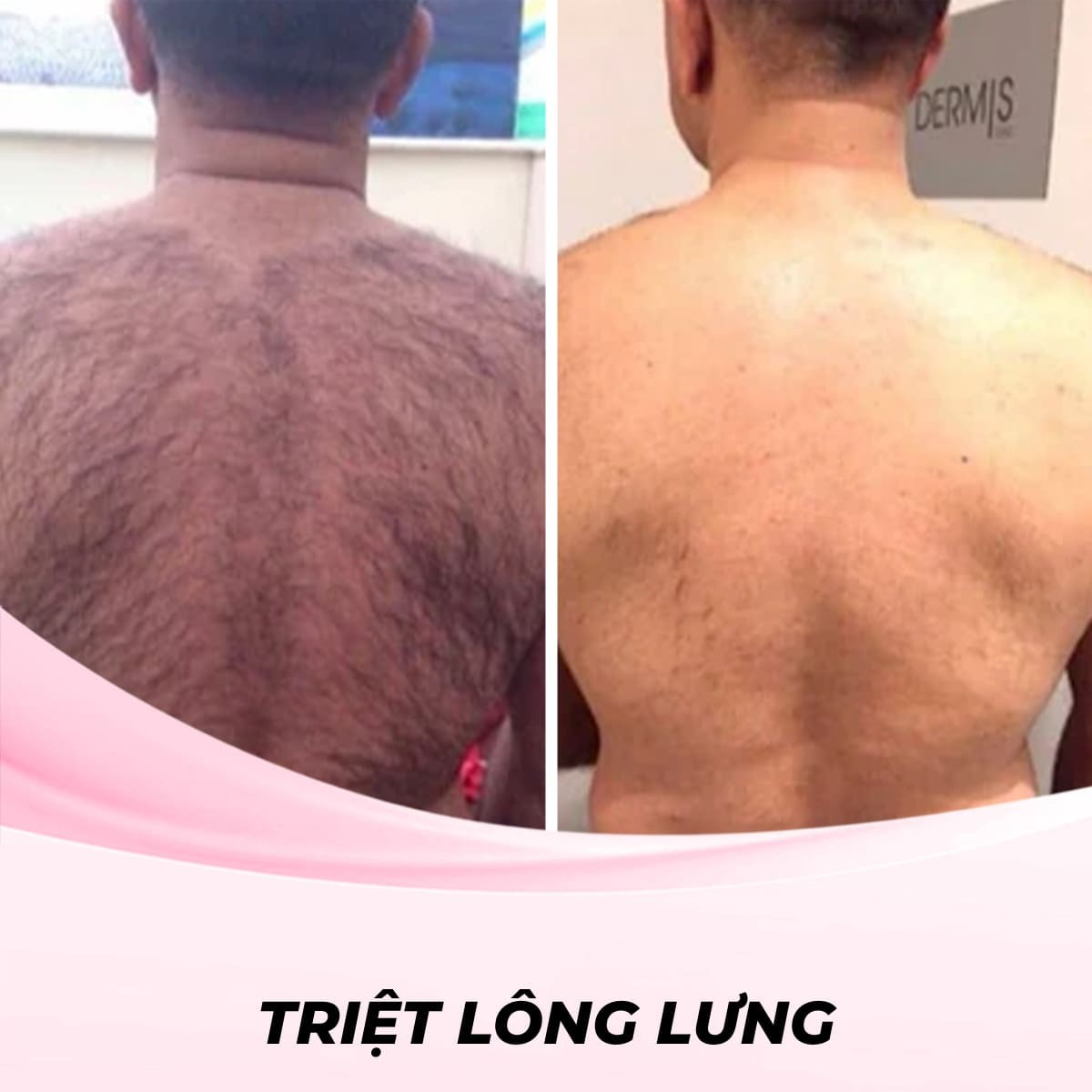 Triệt lông lưng bằng phương pháp Waxing