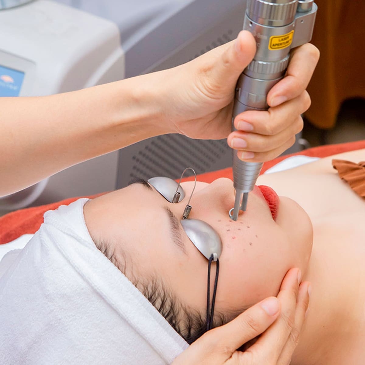 Xử lý  nám bằng công nghệ Laser Toning