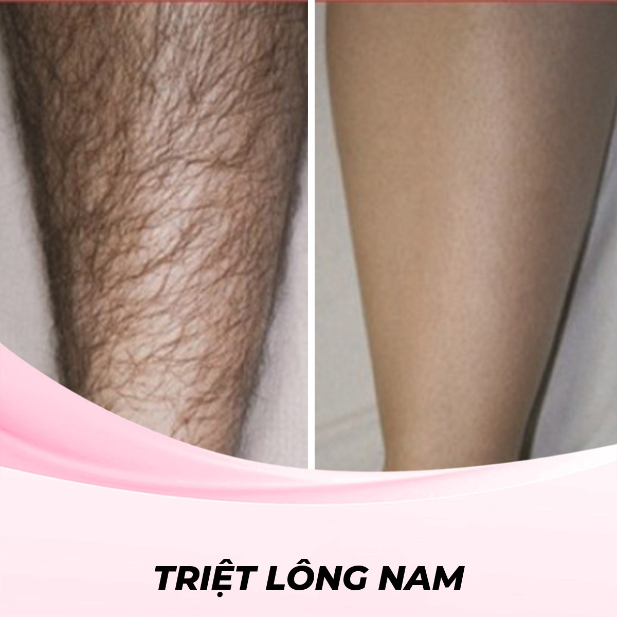 Dịch vụ Triệt Lông Chân cho Nam Bằng Waxing