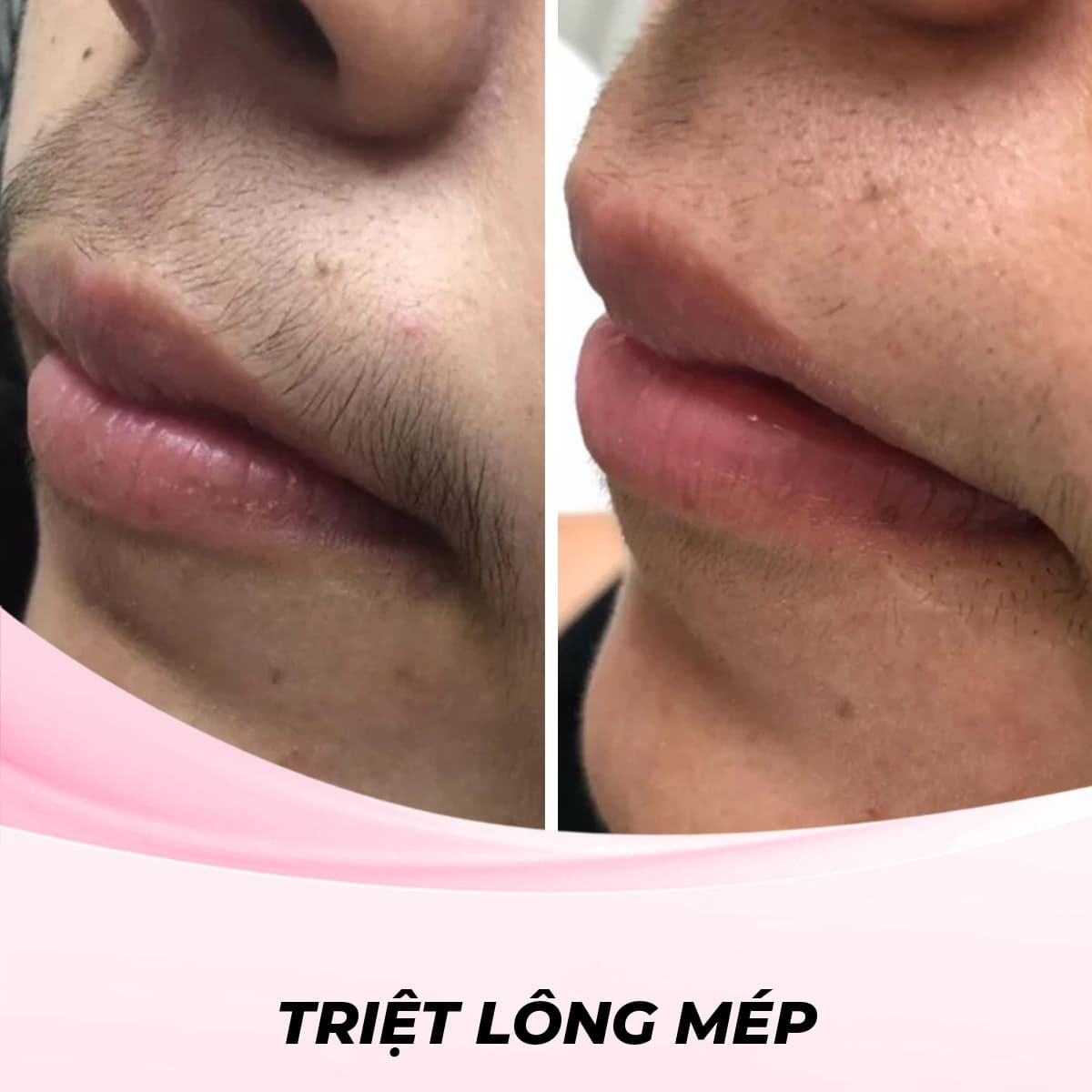 Triệt Lông Mép Bằng Waxing