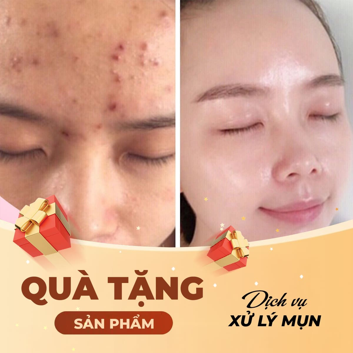Tặng sản phẩm làm đẹp khi sử dụng dịch vụ xử lý mụn - kiểm soát dầu với công nghệ Toning Laser