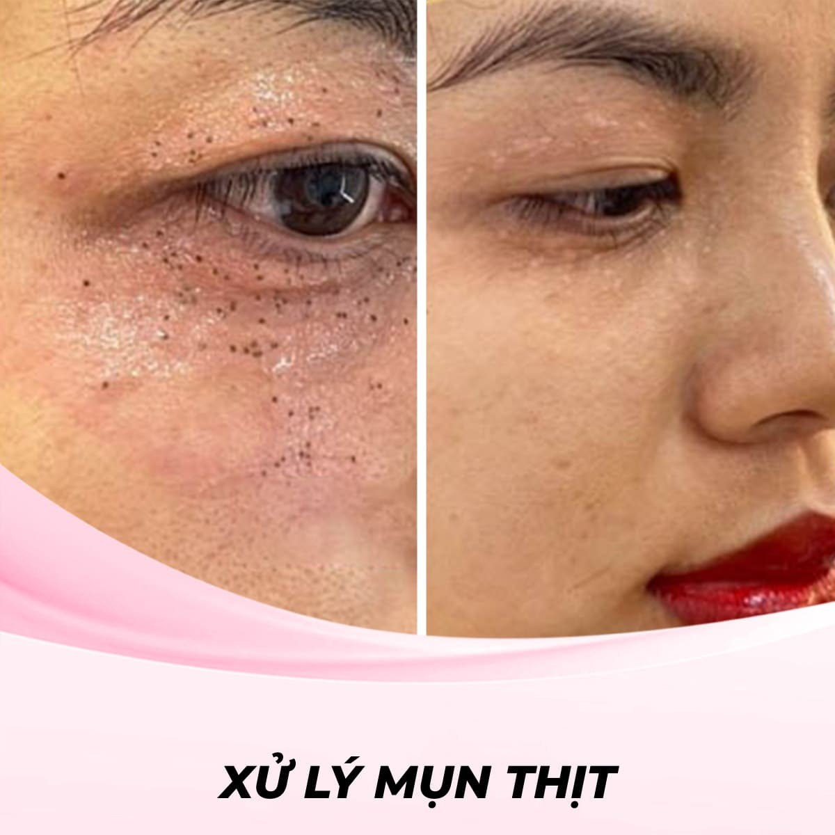 Xử Lý Mụn Thịt Bằng Laser