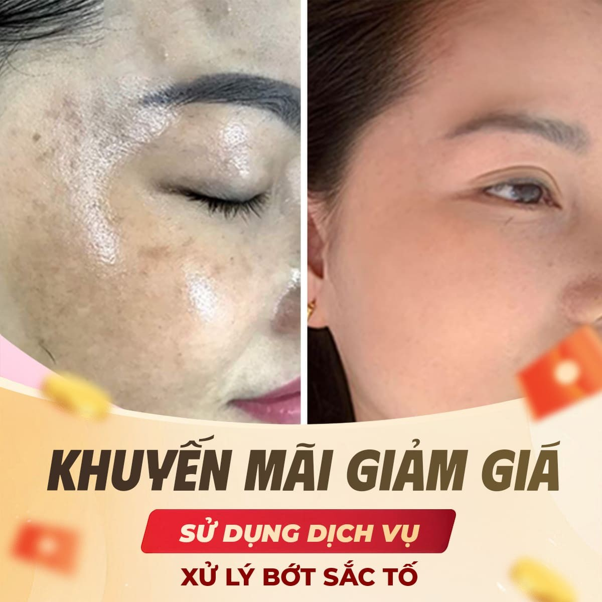 Khuyến Mãi Giảm Giá Dịch Vụ Xử Lý Bớt Sắc Tố Bằng Vi Kim Tảo Biển