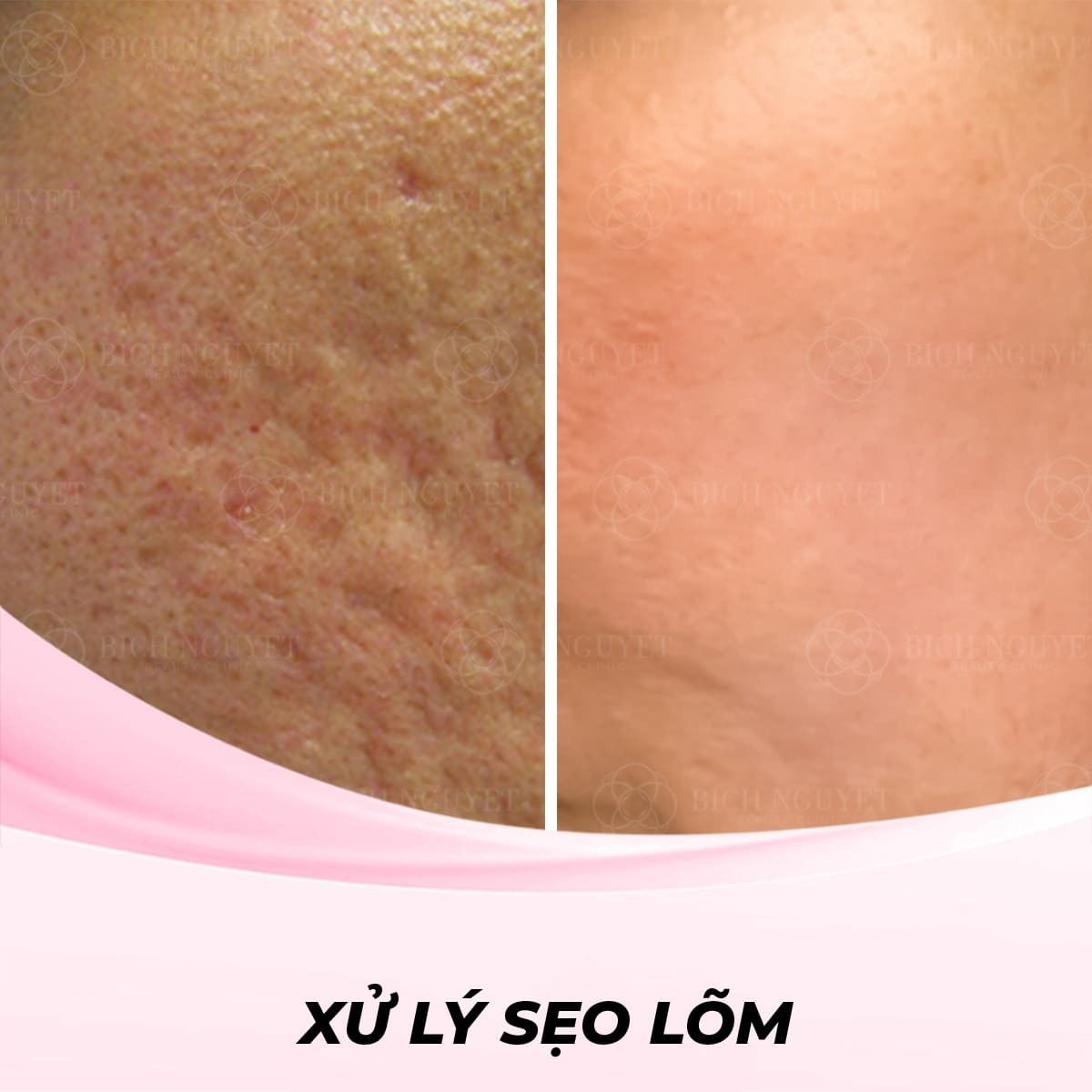 Xử Lý Sẹo Lõm Bằng Phương Pháp PRP (Platelet-Rich Plasma)