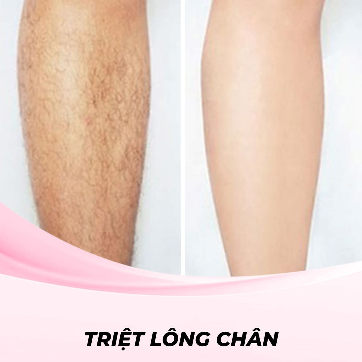 Triệt lông chân bằng công nghệ Laser Alexandrite