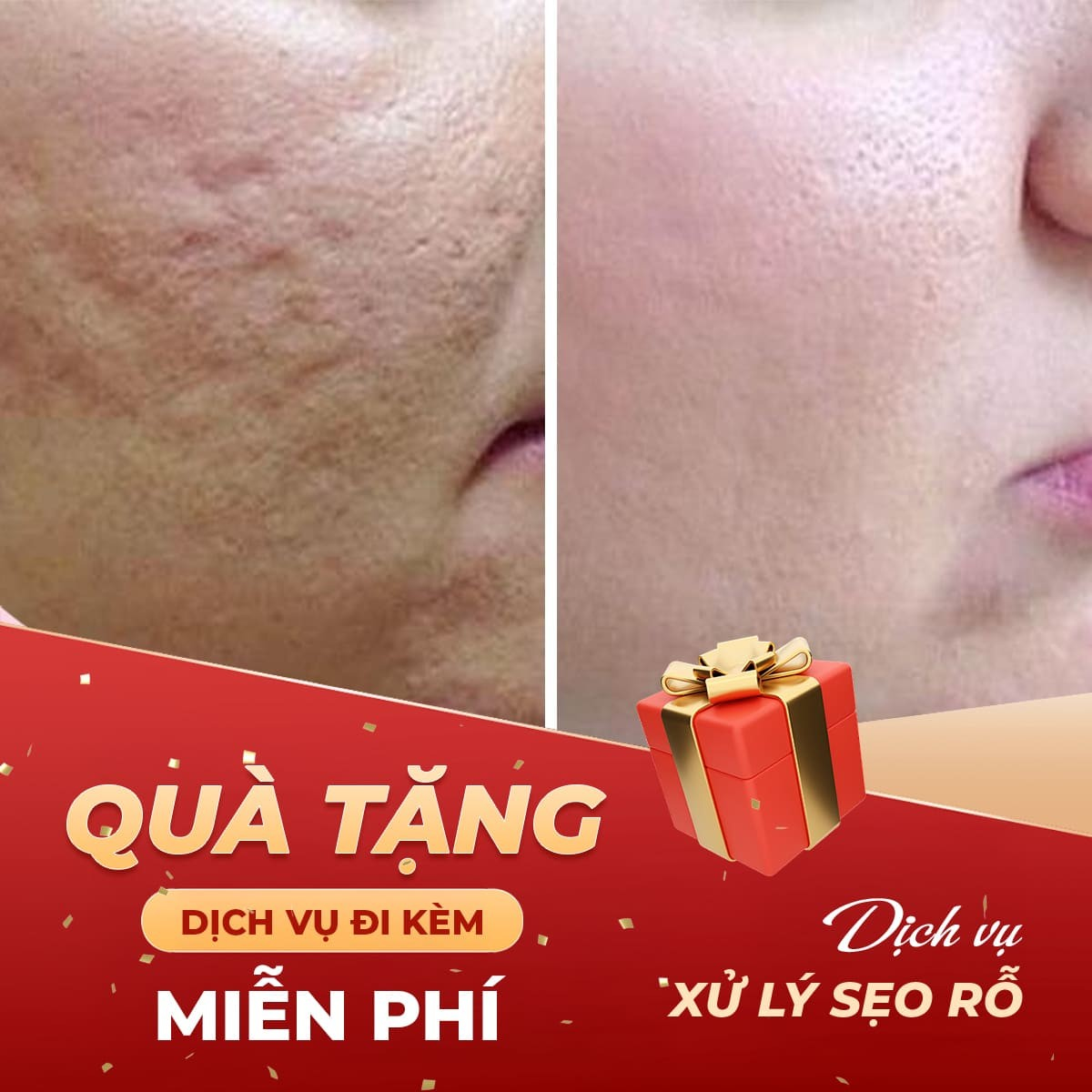 Tặng 1 Dịch Vụ Khi Sử Dụng Dịch Vụ Xử Lý Sẹo Rỗ Bằng Phương Pháp Cryotherapy