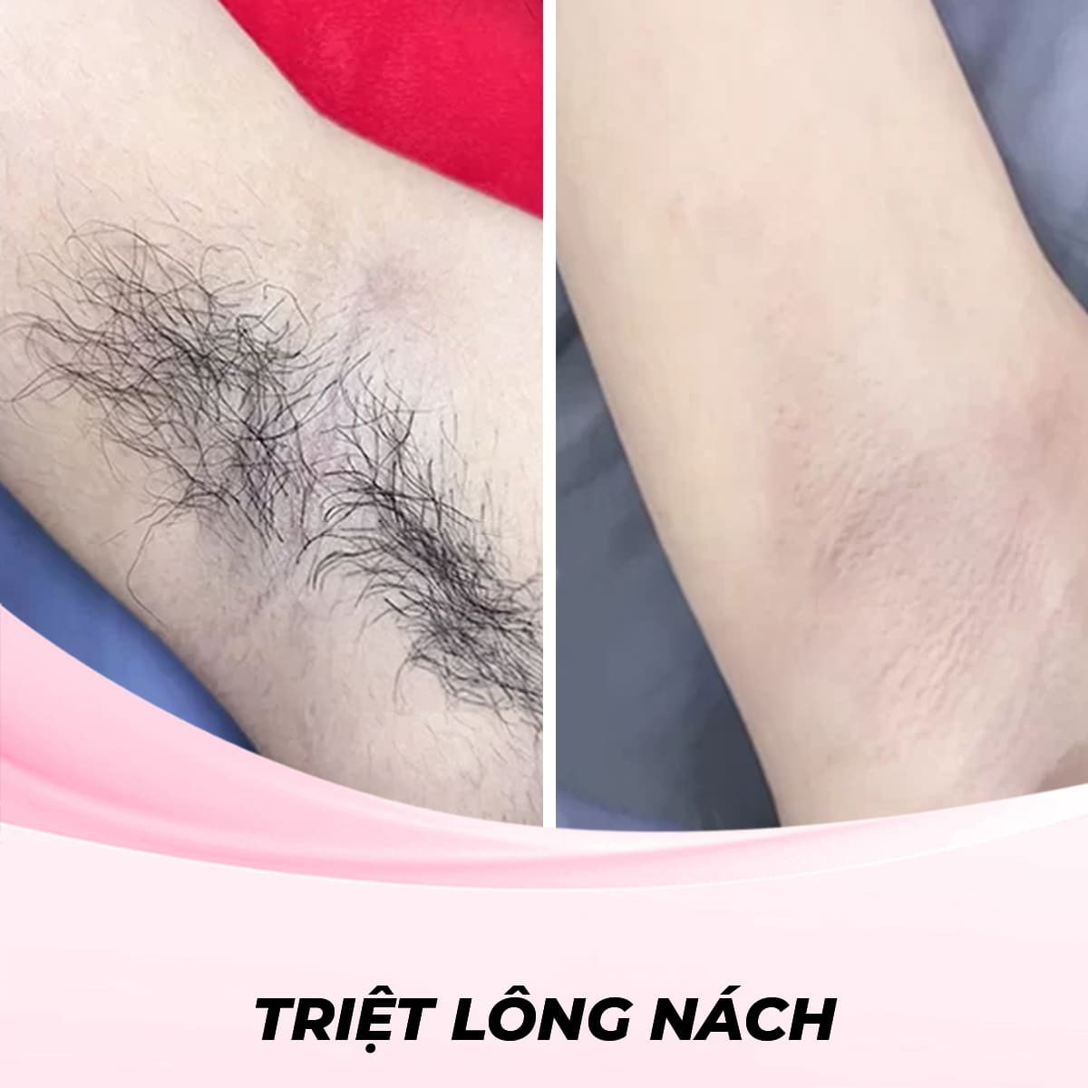 Triệt lông nách bằng công nghệ RF (Radio Frequency) - trải nghiệm