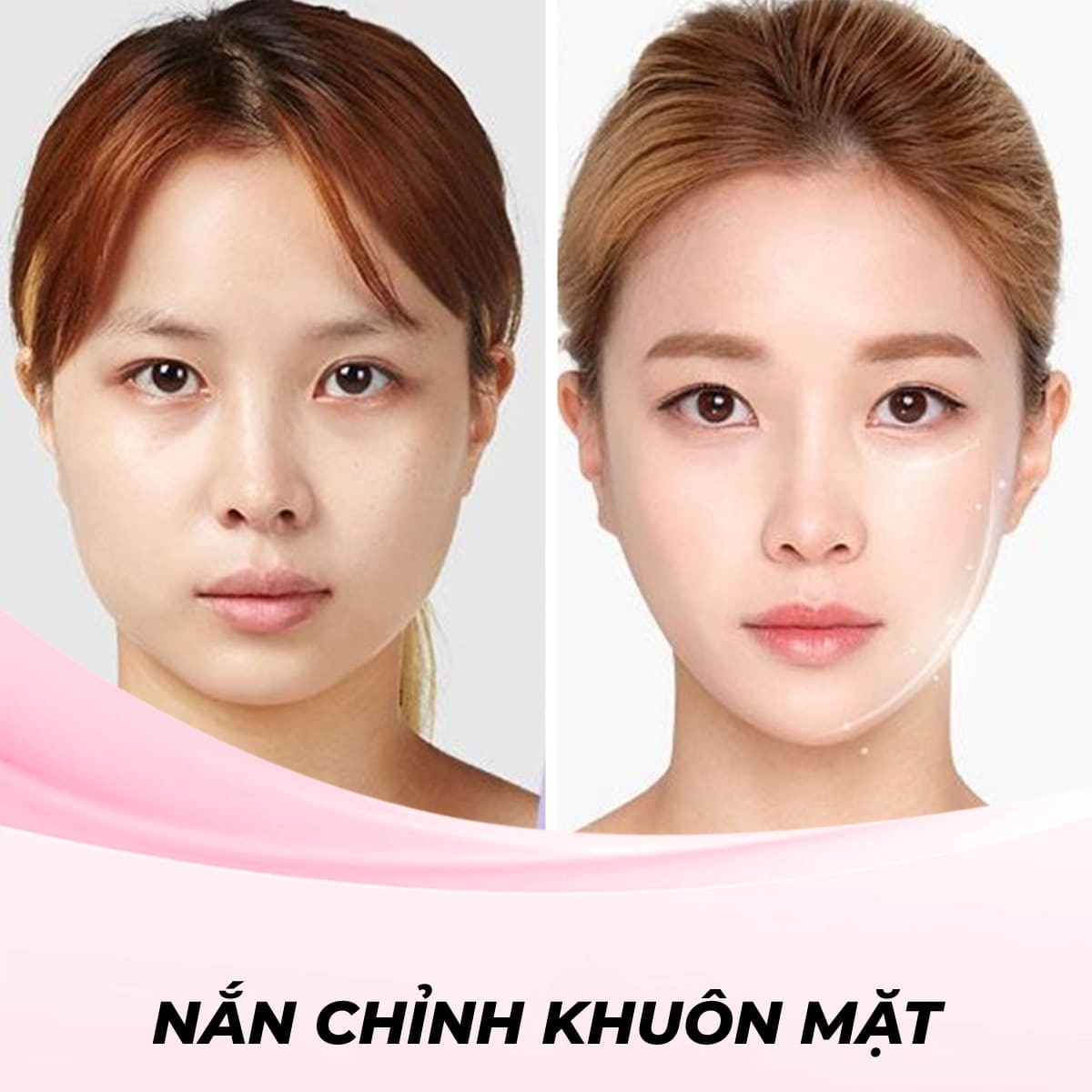 Tạo cằm V-Line bằng công nghệ RF (Radio Frequency)