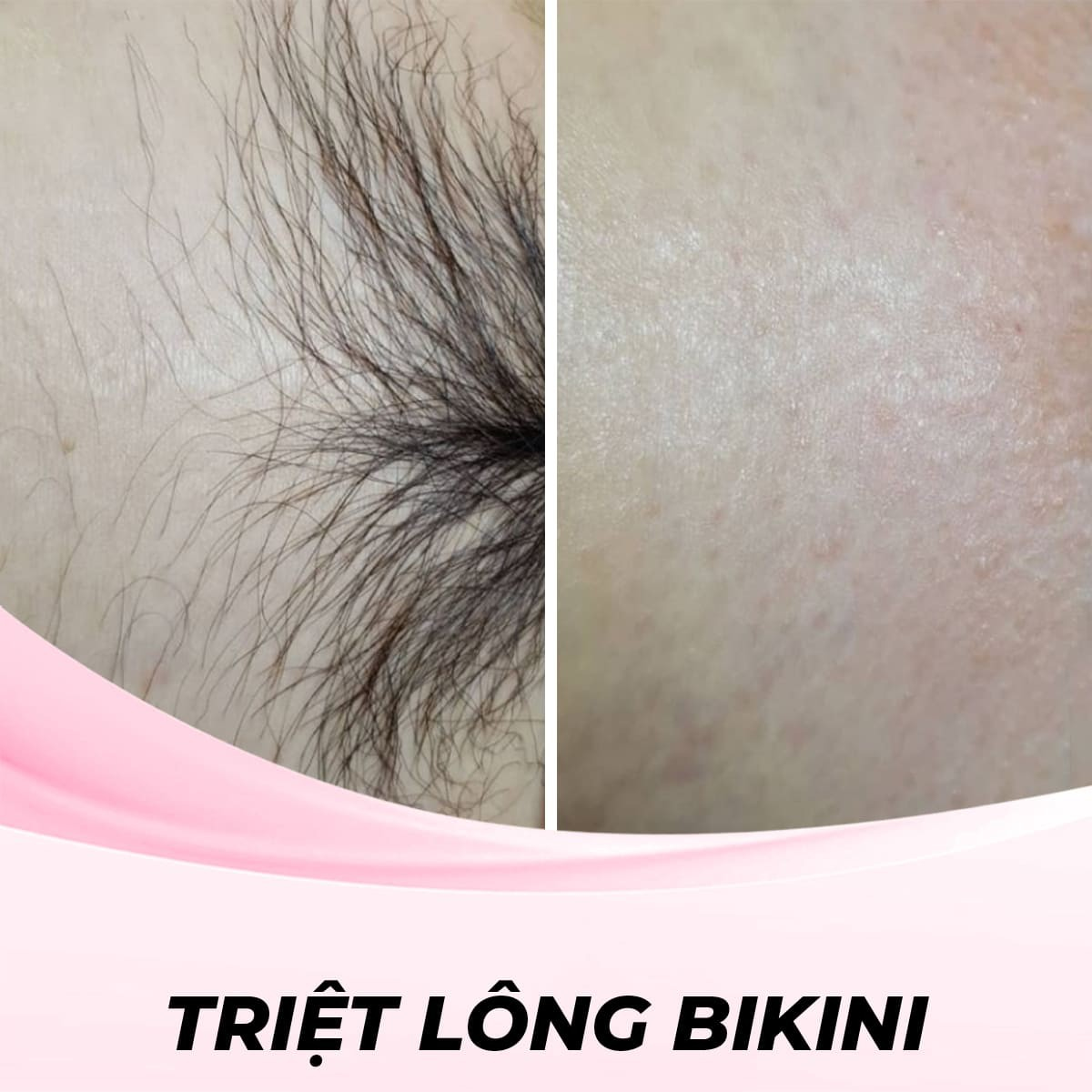 Triệt lông Bikini bằng công nghệ Diode Laser