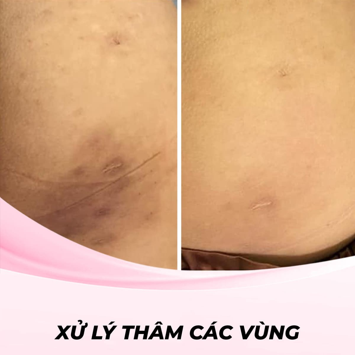 Xử lý thâm mông bằng phương pháp laser