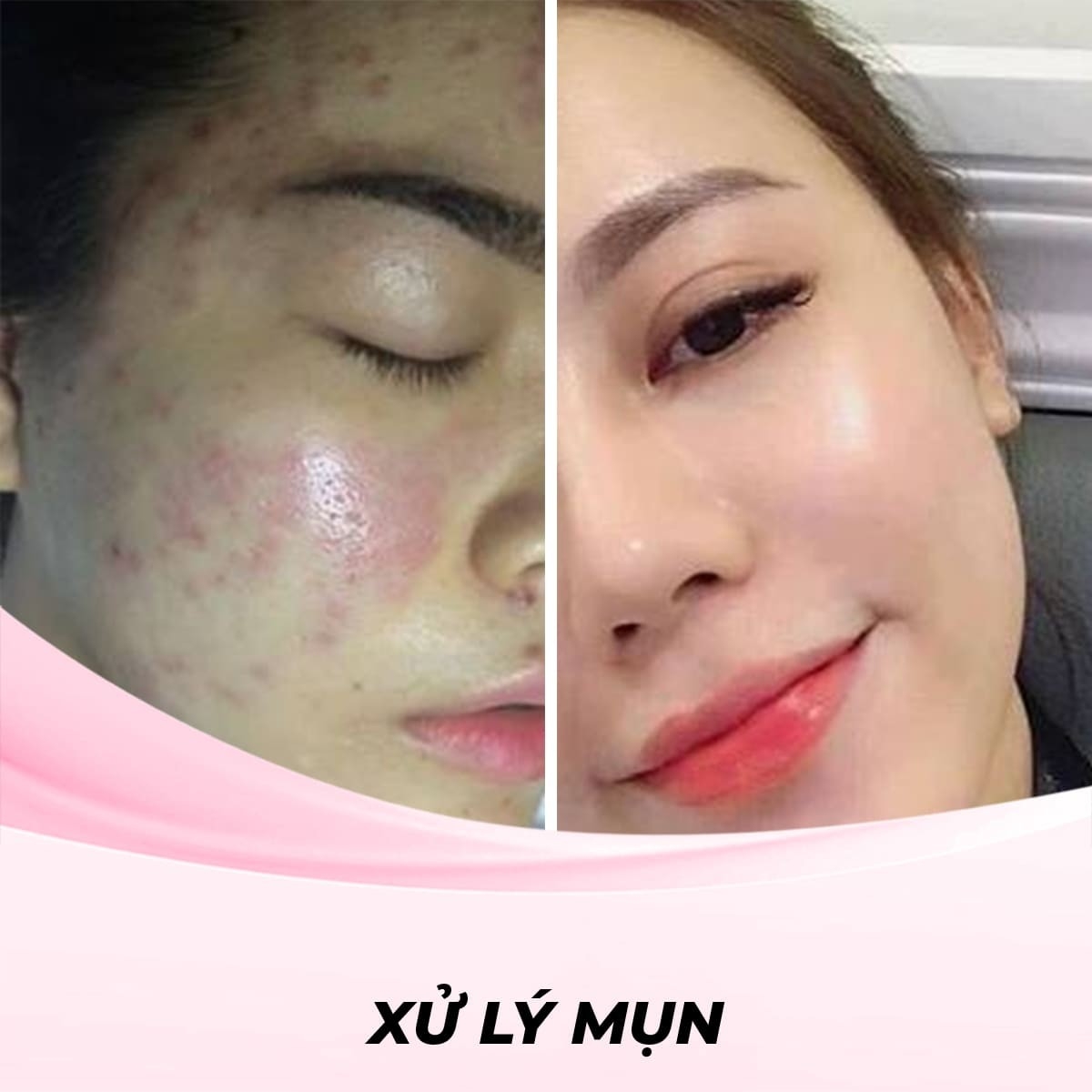 Xử lý mụn bằng liệu trình Detox Da