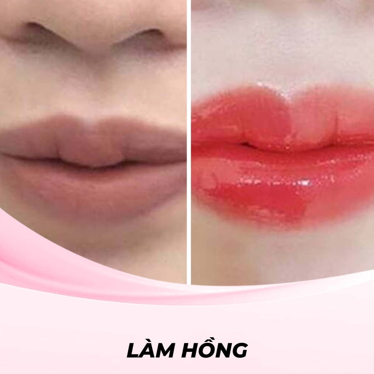 Làm hồng môi bằng công nghệ RF