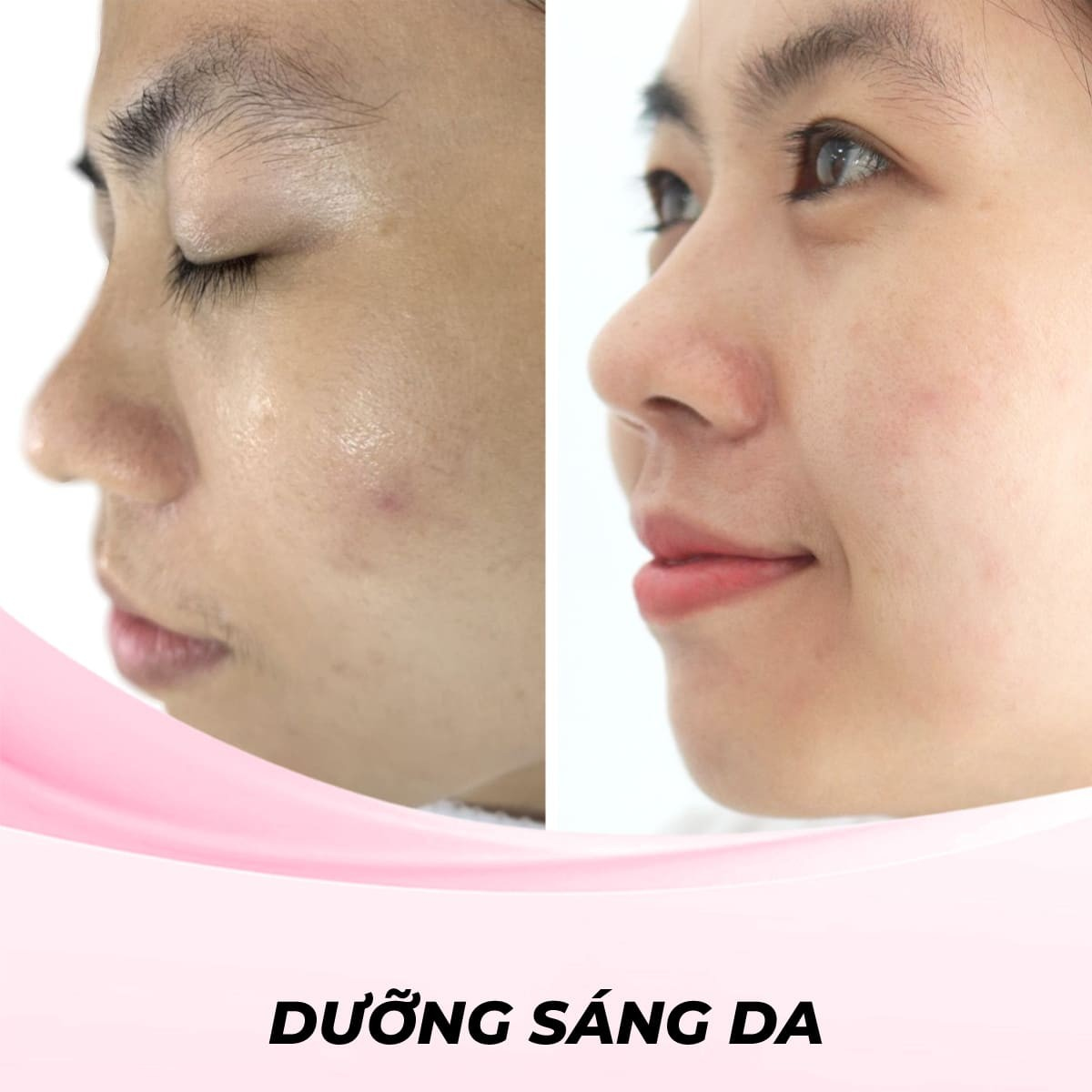 Dịch Vụ Cấy Tinh Chất Glutathione Dưỡng Trắng - Da mặt