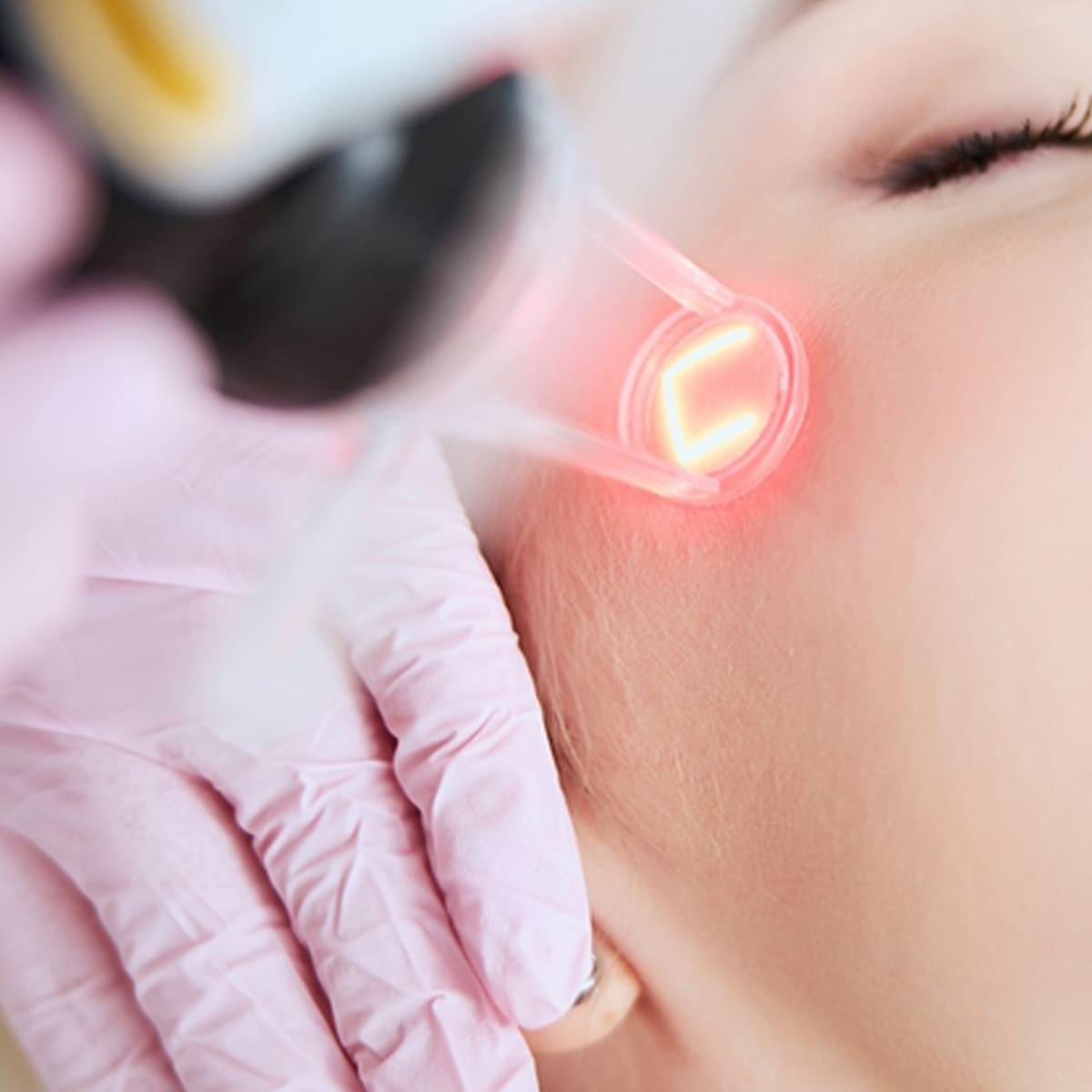 Xử Lý Mụn Thịt Bằng Laser