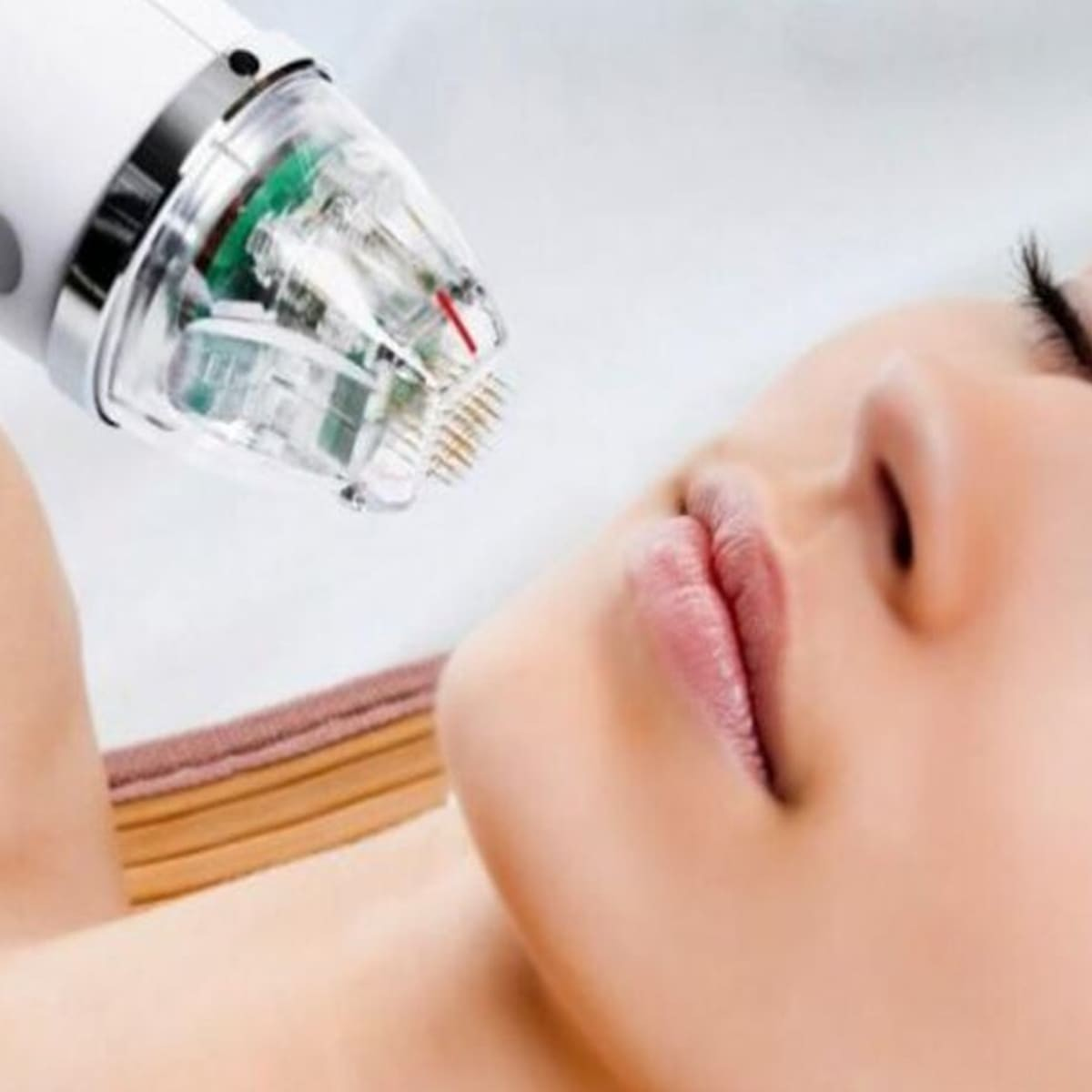 Xử Lý Sẹo Lõm Bằng Sóng Radiofrequency (RF)