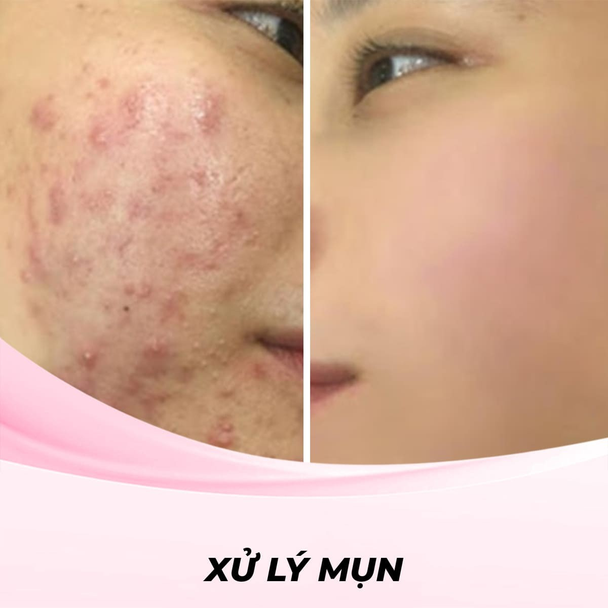 Dịch vụ Xử Lý Mụn bằng Ánh sáng xanh (Blue Light Therapy)