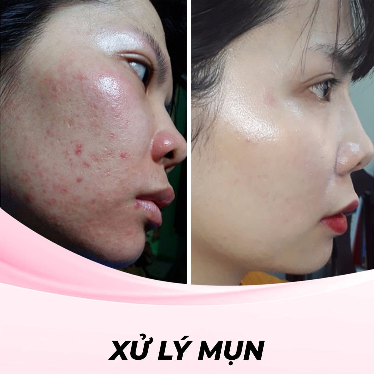 Xủ lý Mụn Bằng Công Nghệ IPL
