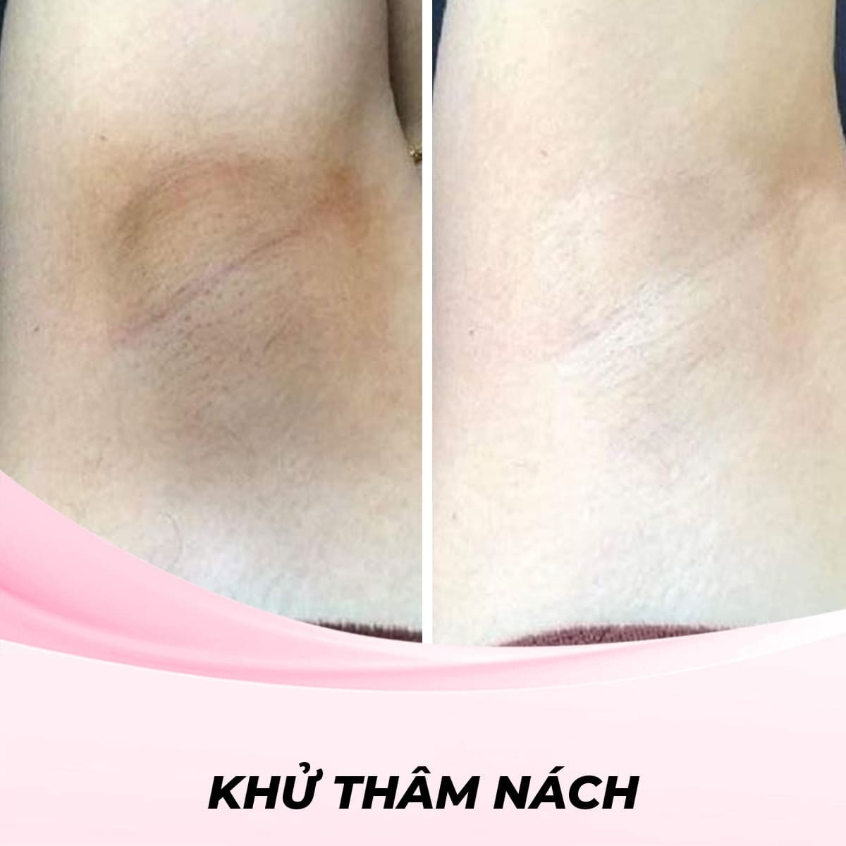 Khử thâm nách bằng phương pháp Peel da hóa học
