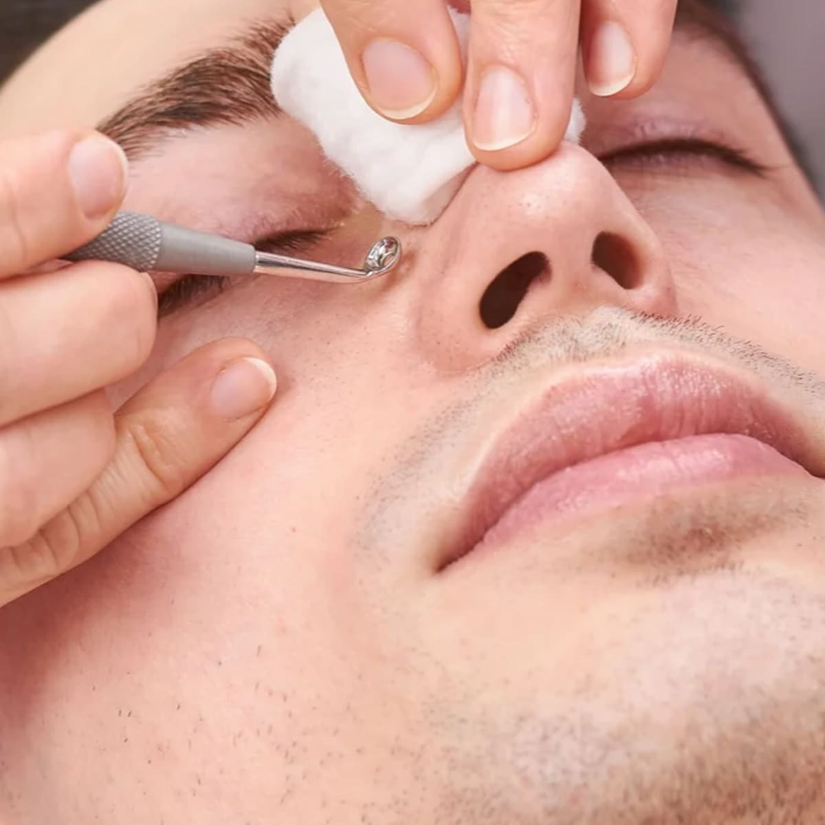 Phương Pháp Hút Mụn Đầu Đen