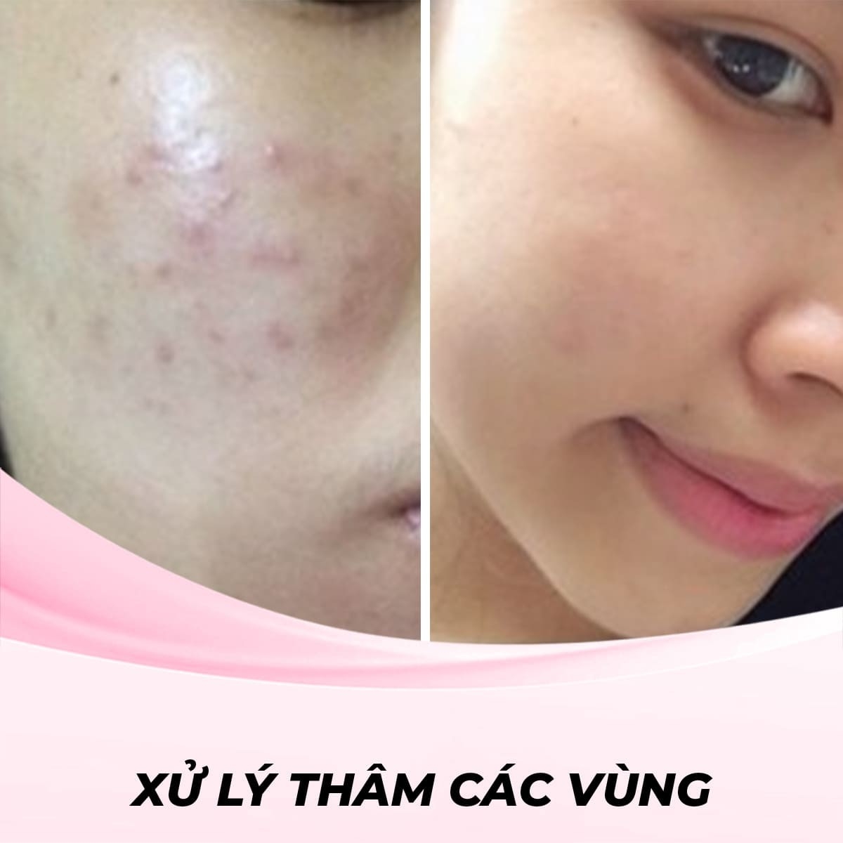 Xử lý sẹo thâm do mụn mặt bằng phương pháp laser