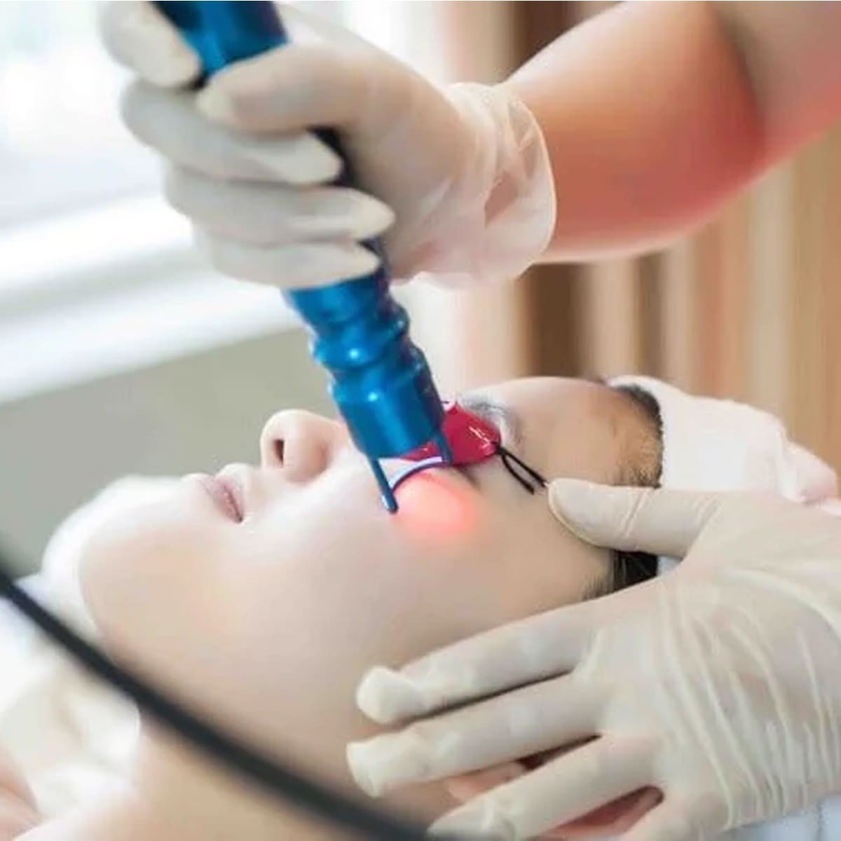 Xử lý sẹo thâm do mụn mặt bằng phương pháp laser