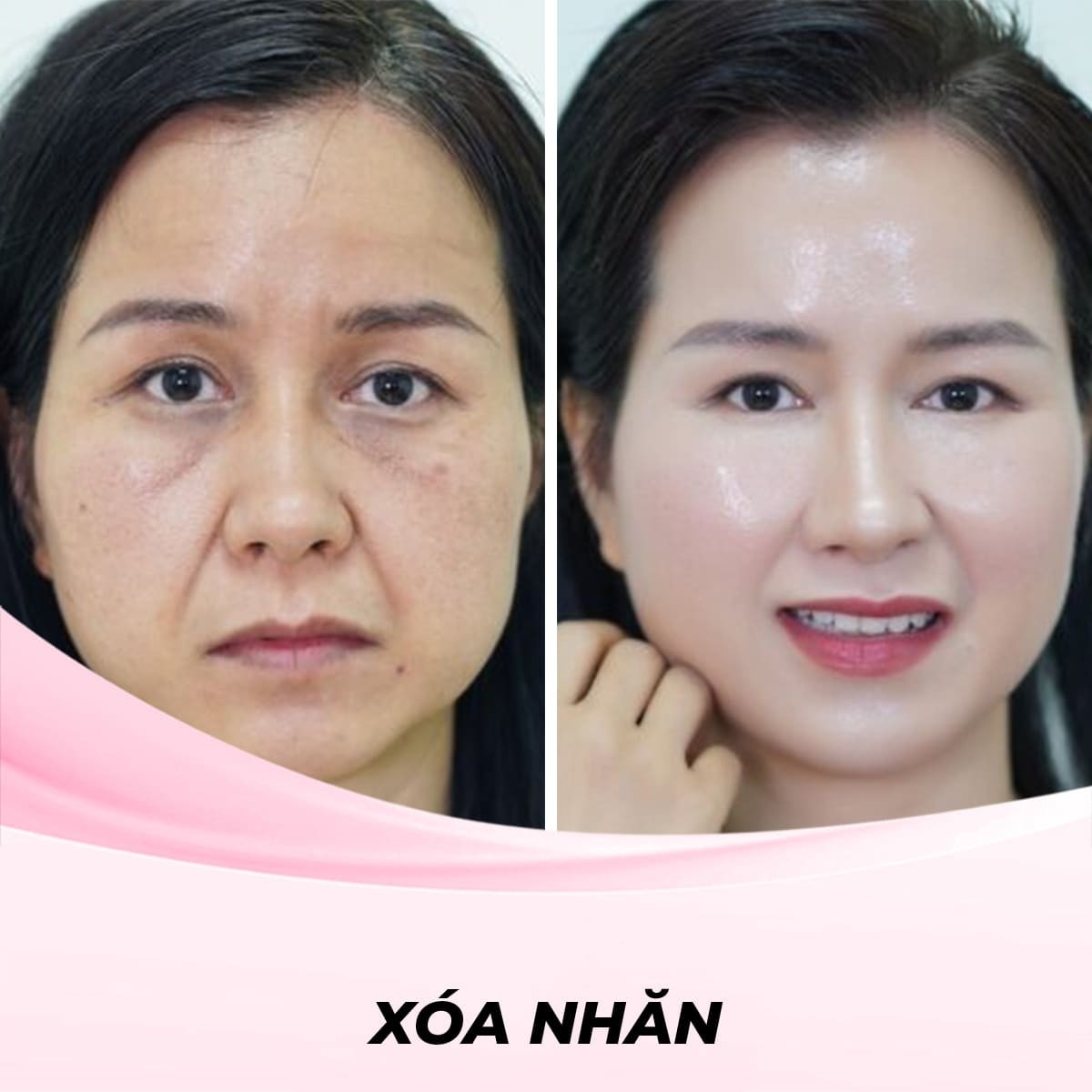 Xóa Nhăn Bằng Công Nghệ Plano