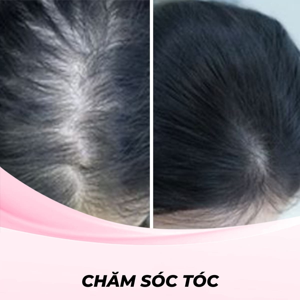 Tăng sinh Mầm Tóc Vi Bào STEMCELL