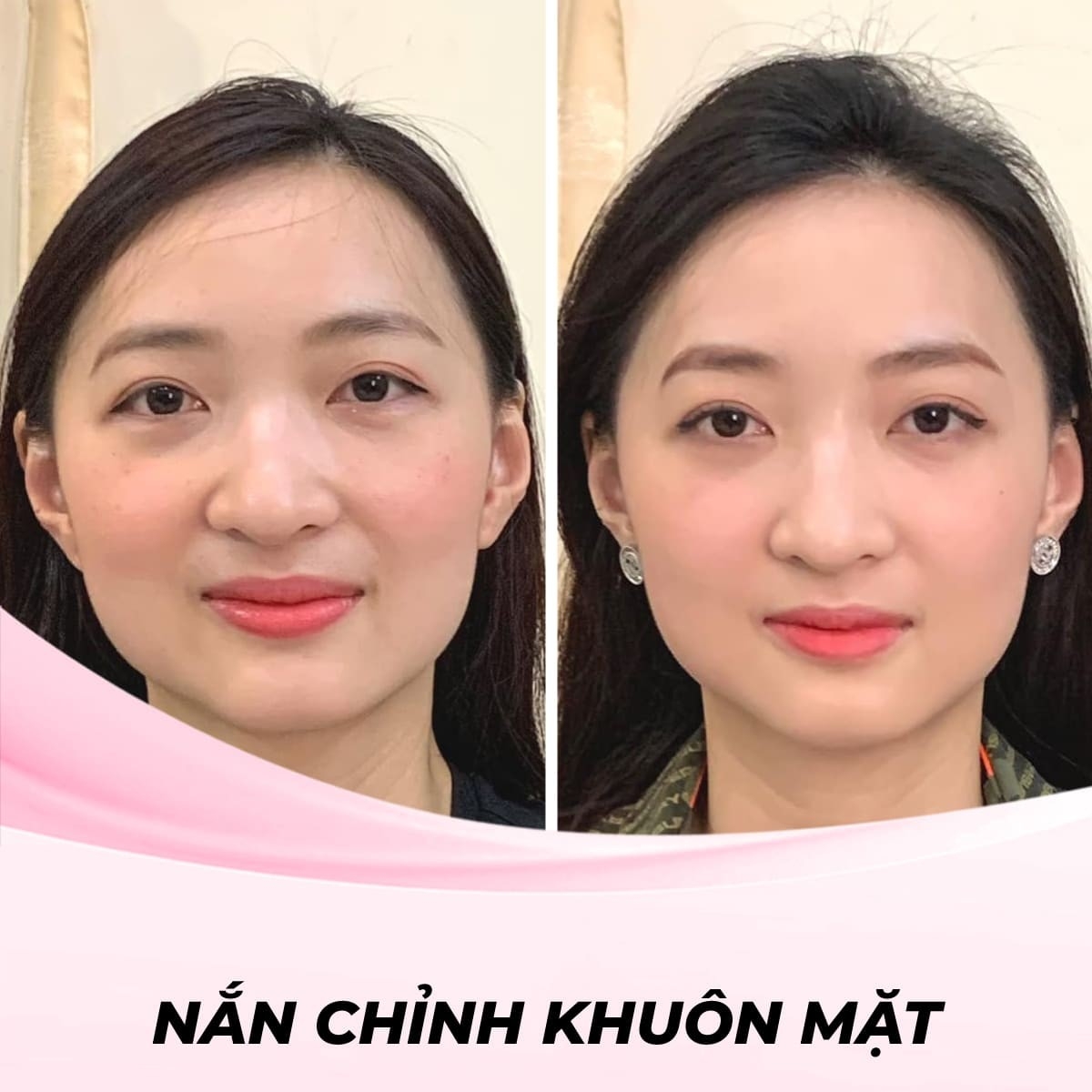 Nắn chỉnh mặt lệch Đông y bằng tay