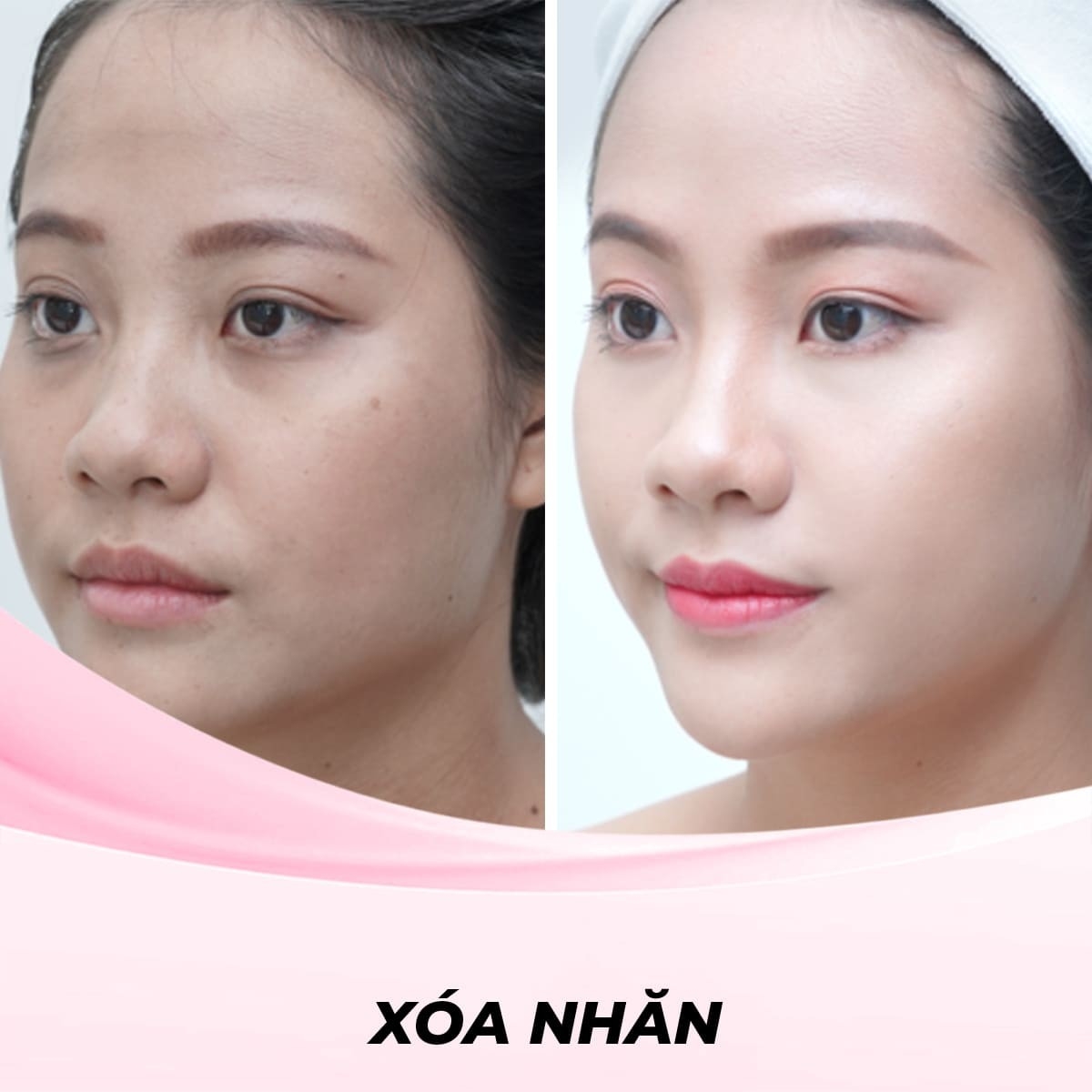 Công nghệ FOTONA 6D PRO - Trẻ hóa da