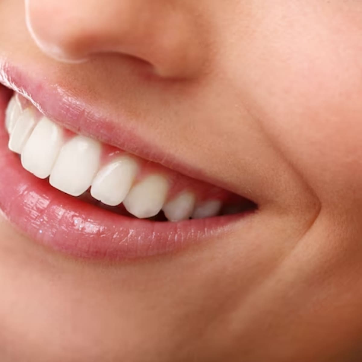 Dán Sứ Viva Ultrathin